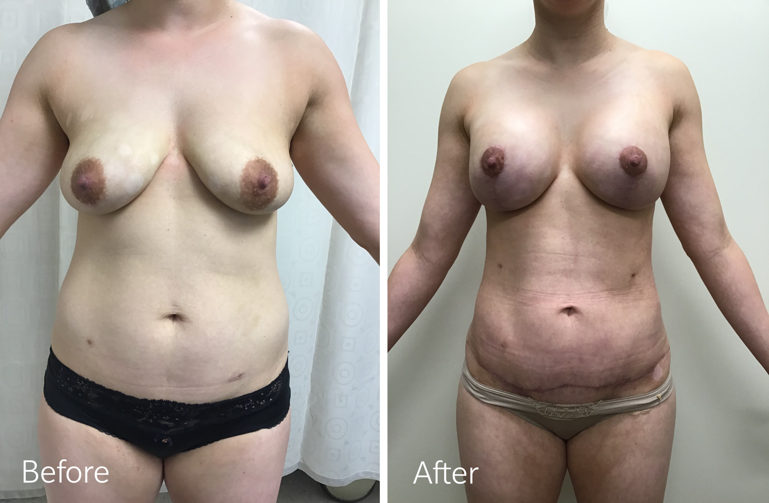 Breast lift and augmentation surgery by Dr. Steven Porto