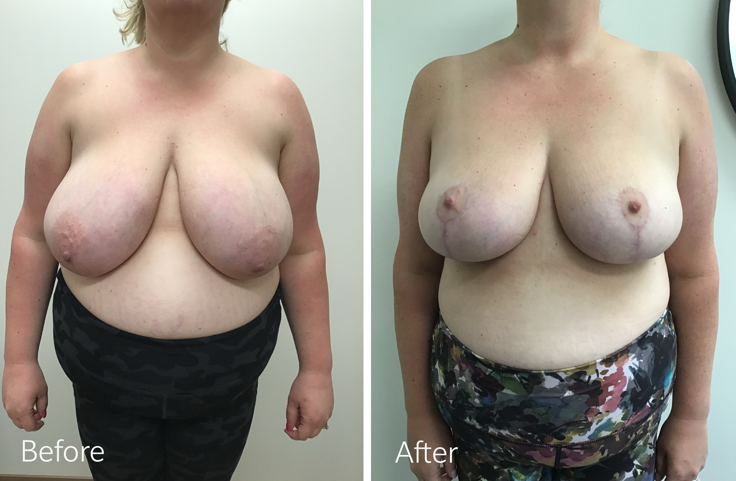 Breast reduction surgery by Dr. Steven Porto