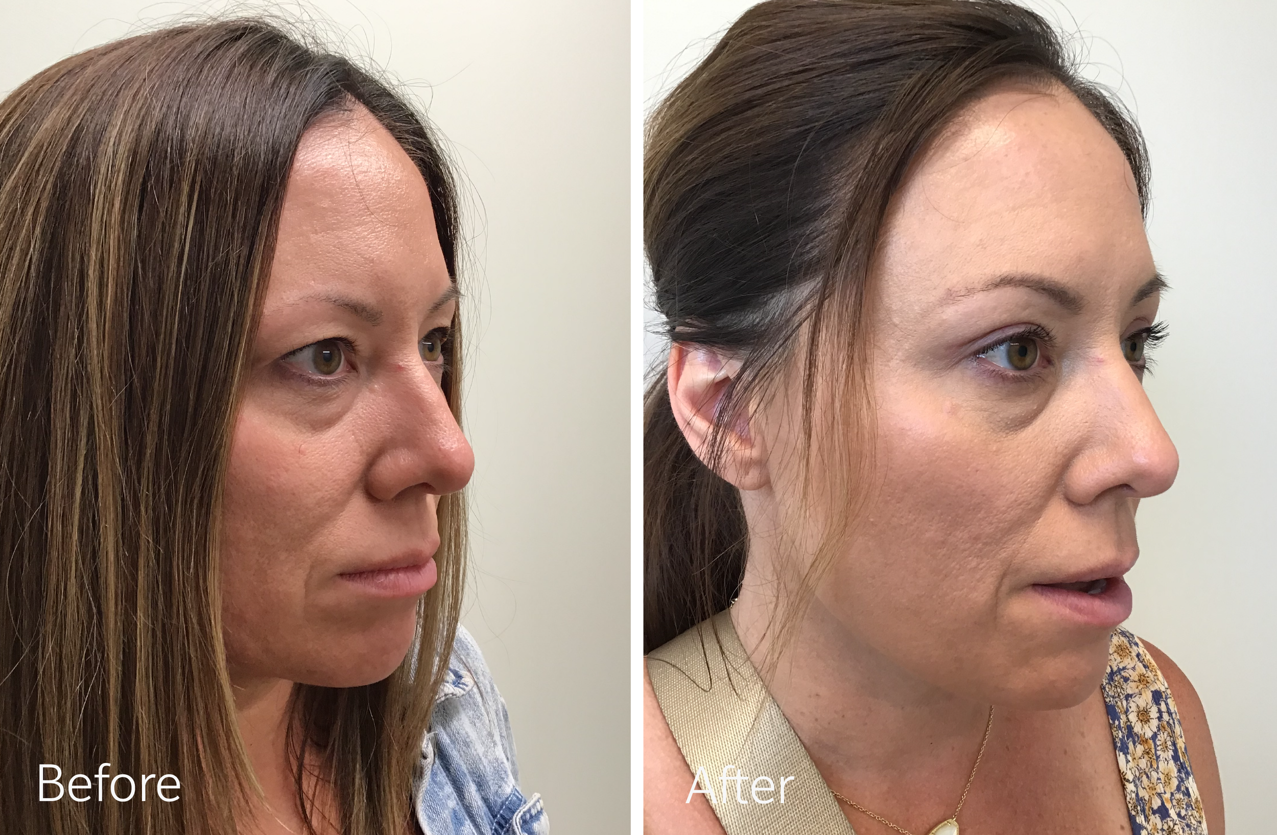 Eyelid surgery by Dr. Steven Porto, Board Certified Plastic Surgeon in Indianapolis, Indiana