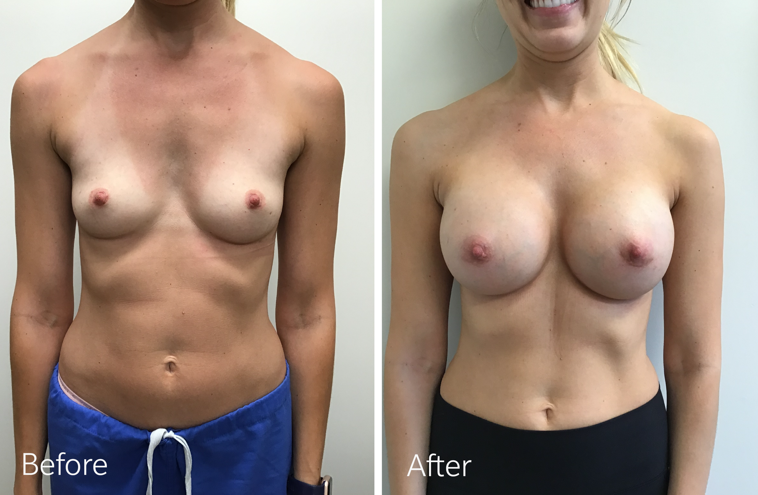 Breast Augmentation Surgery with 400cc Implants by Dr. Steven Porto