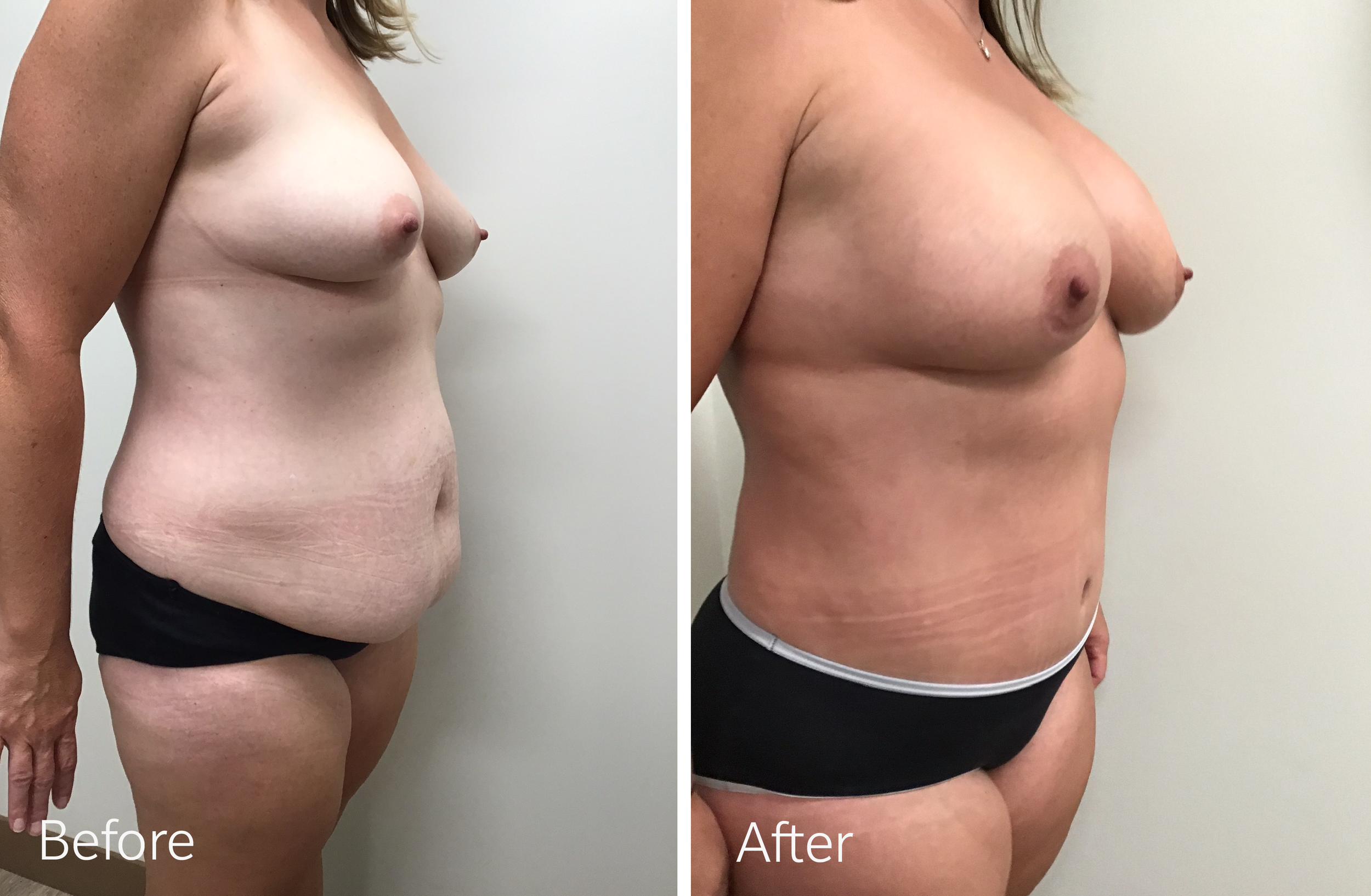 Tummy tuck, breast lift and implant surgery by Dr. Steven Porto, Board Certified Plastic Surgeon in Indianapolis, Indiana
