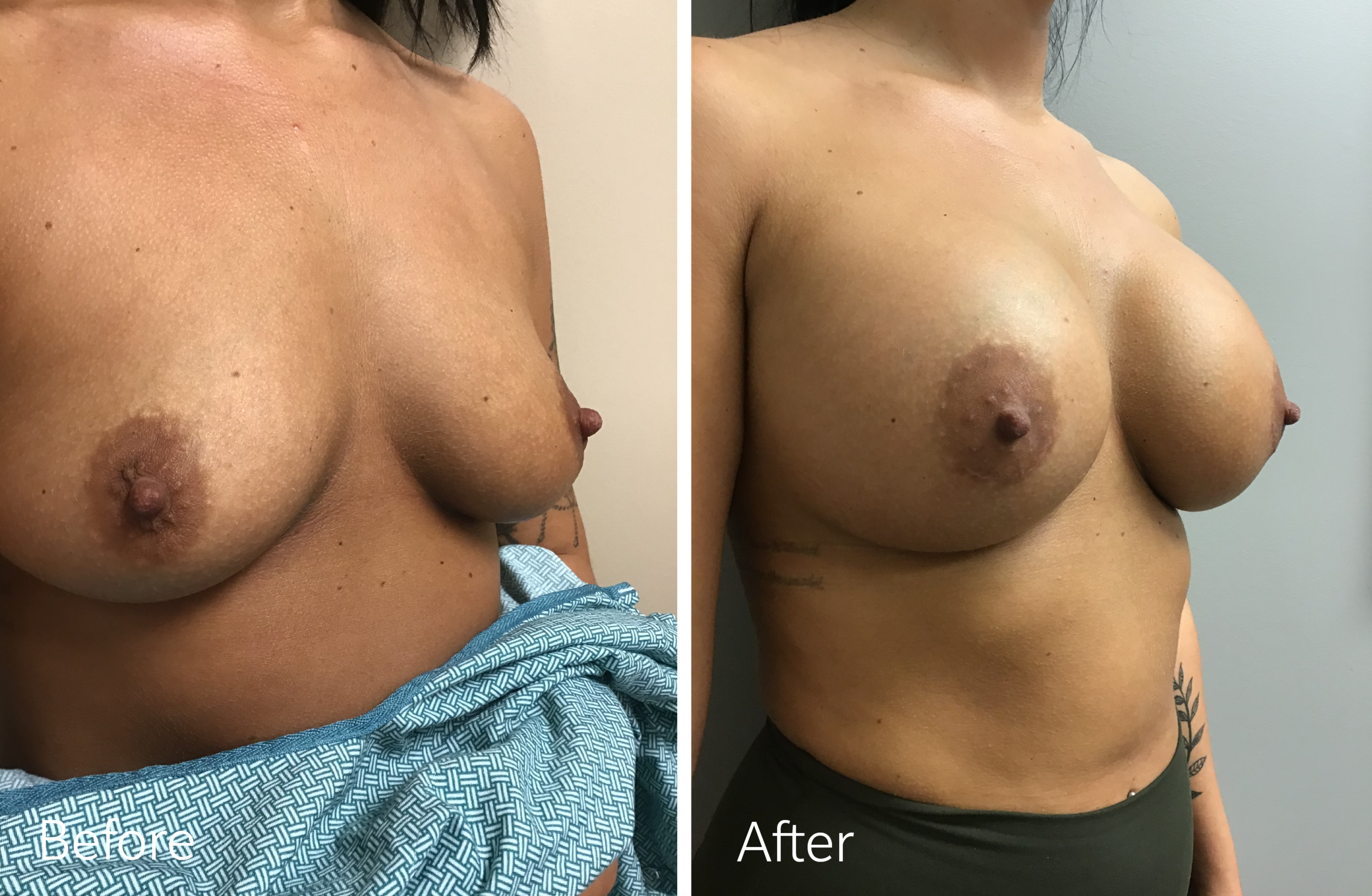 Breast Augmentation Surgery with 420cc Implants by Dr. Steven Porto