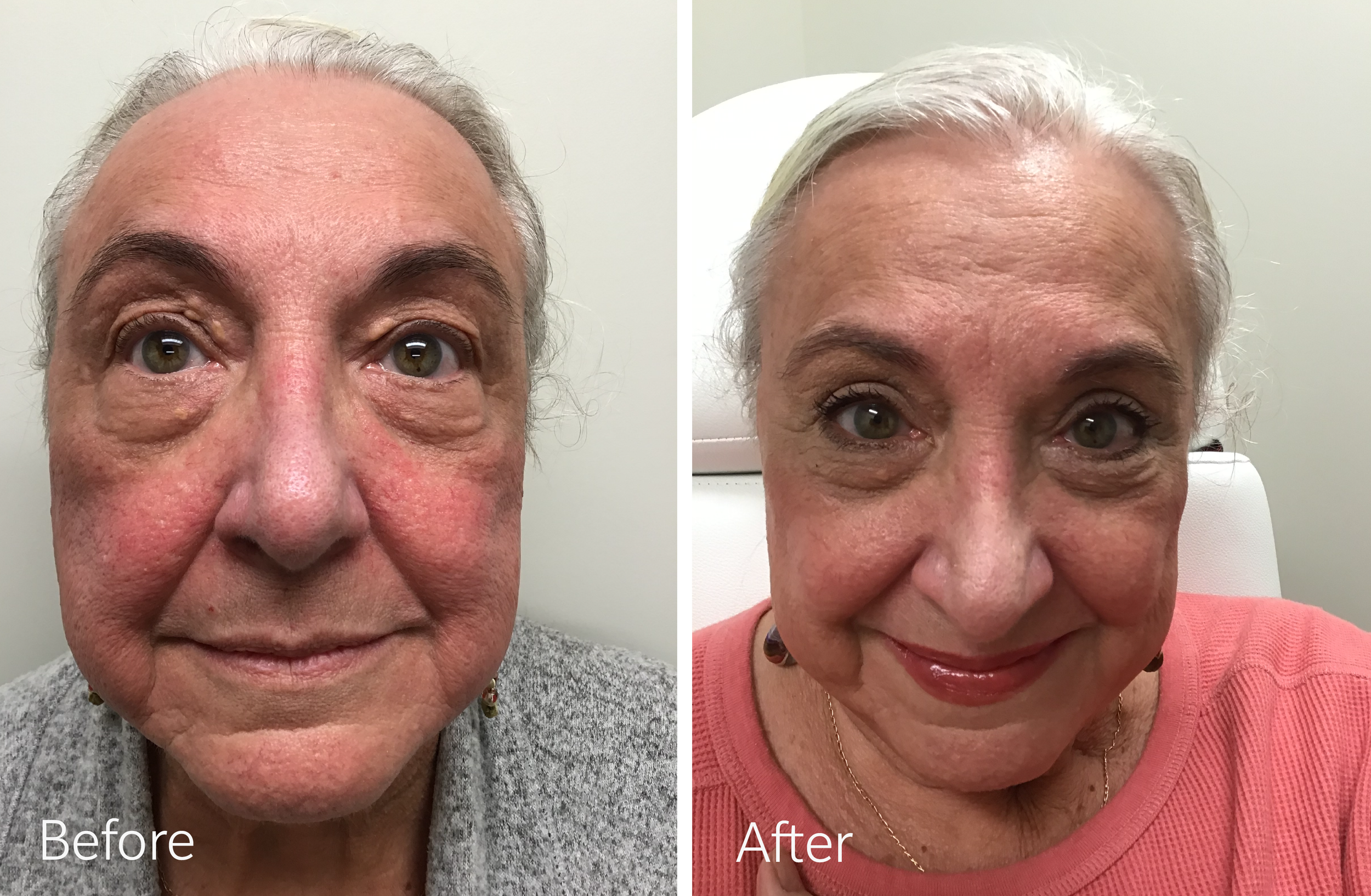 Eyelid surgery by Dr. Steven Porto, Board Certified Plastic Surgeon in Indianapolis, Indiana