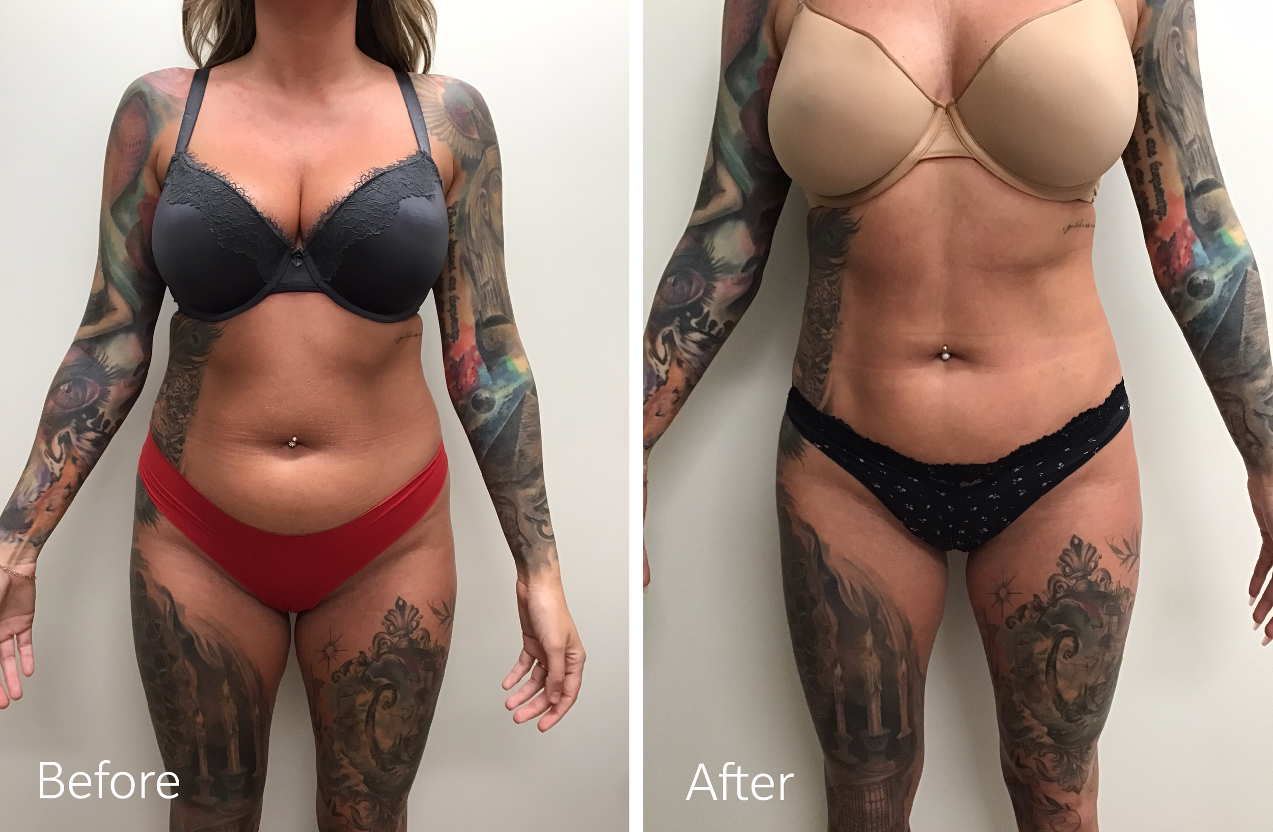 Vaser liposuction plastic surgery by Dr. Steven Porto, Board Certified Plastic Surgeon in Indianapolis, Indiana