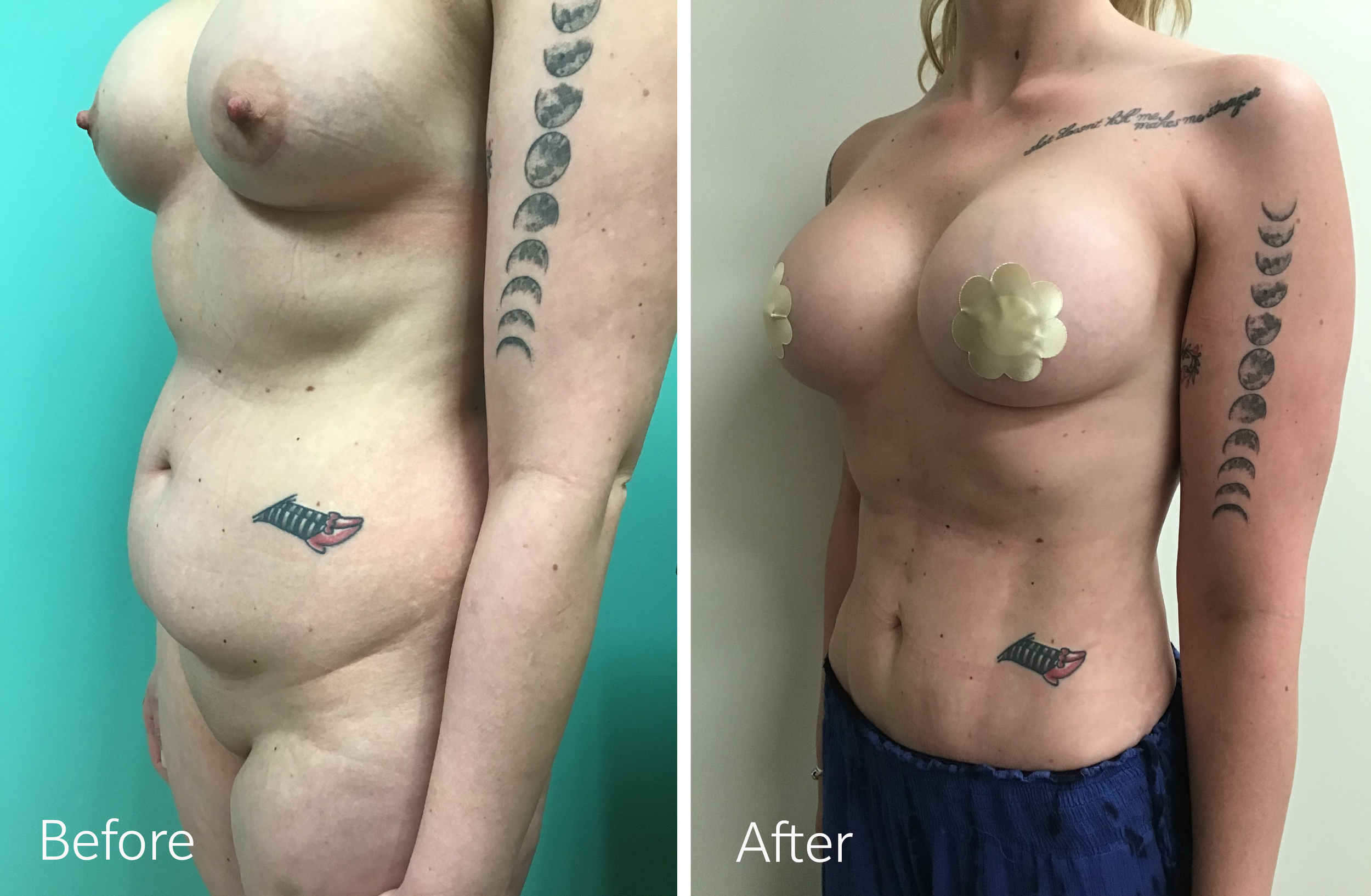 Mommy Makeover Tummy Tuck, Liposuction, Breast Lift and Implants by Dr. Steven Porto, Board Certified Plastic Surgeon in Indianapolis, Indiana