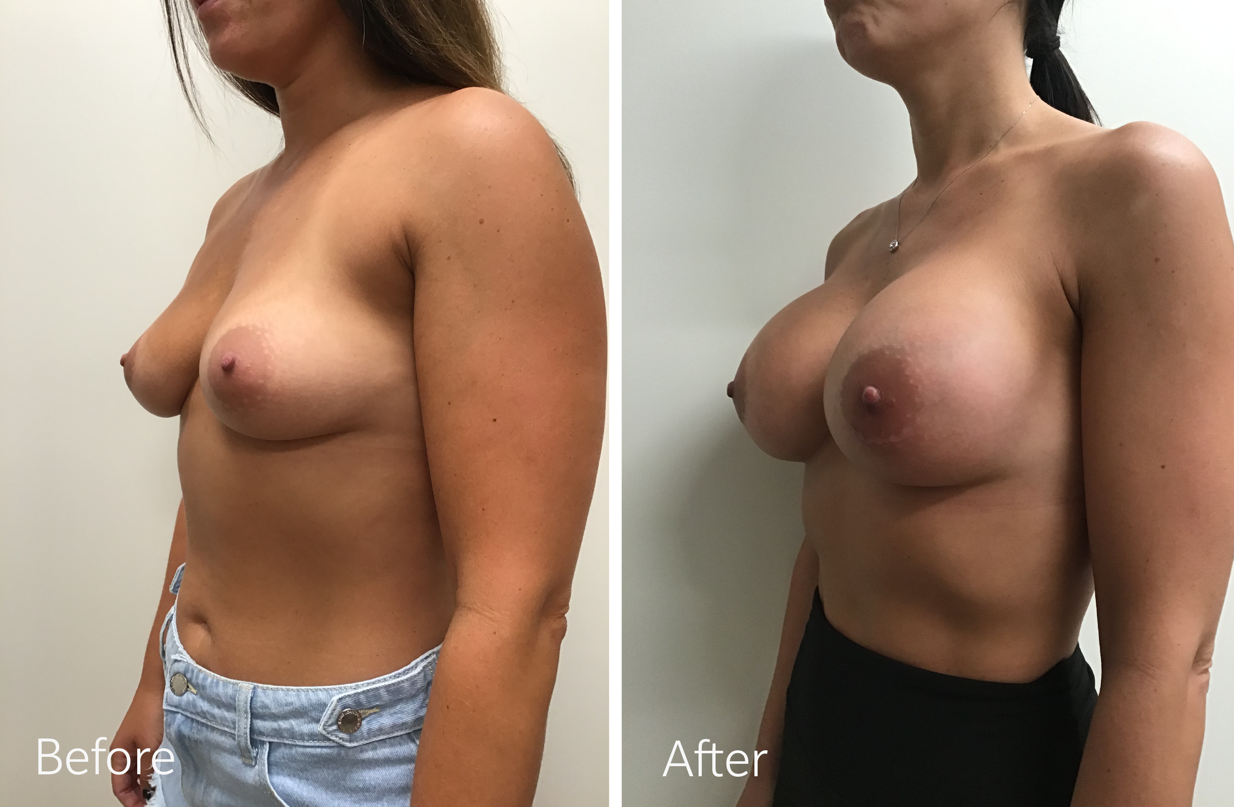 Breast Augmentation Surgery with 430cc Implants by Dr. Steven Porto
