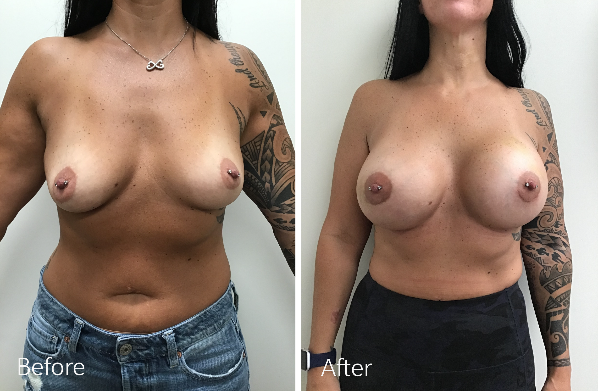 Breast Augmentation Surgery with 415cc Implants by Dr. Steven Porto