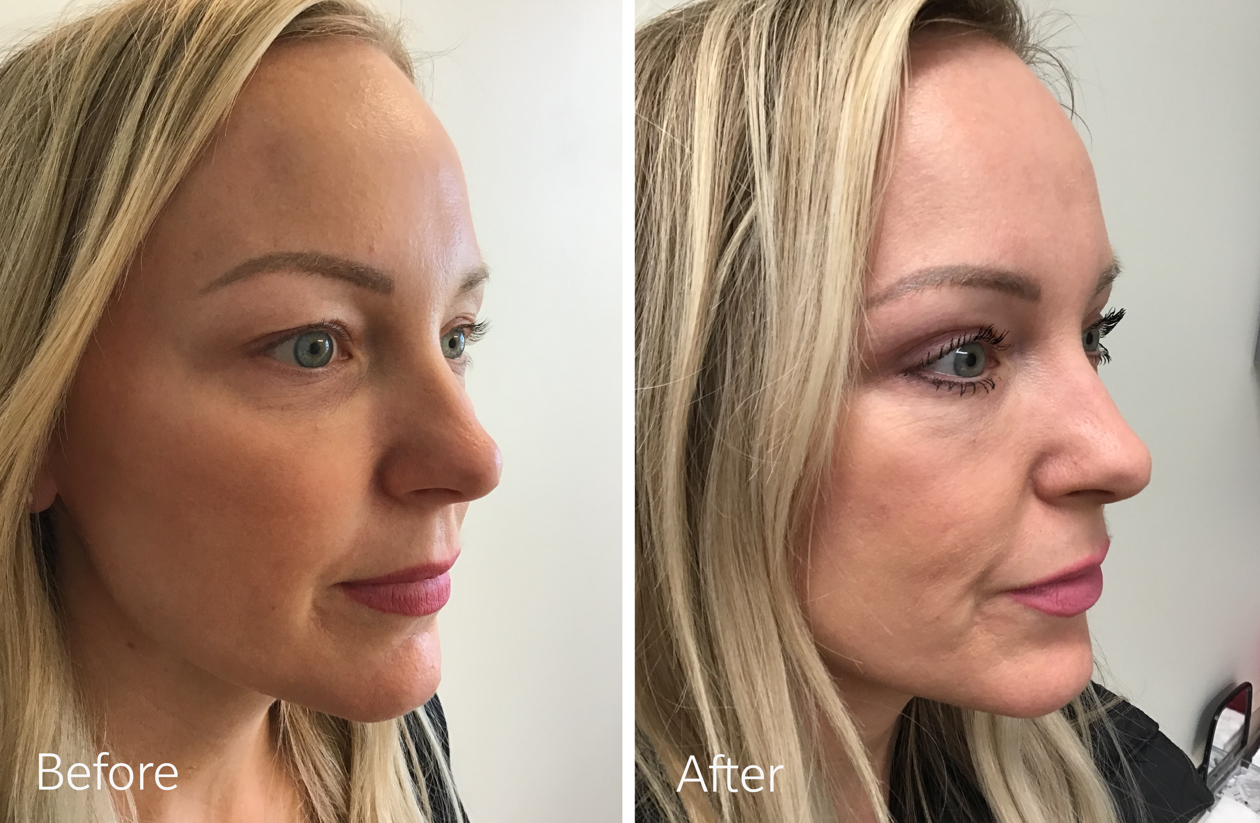 Eyelid surgery by Dr. Steven Porto, Board Certified Plastic Surgeon in Indianapolis, Indiana