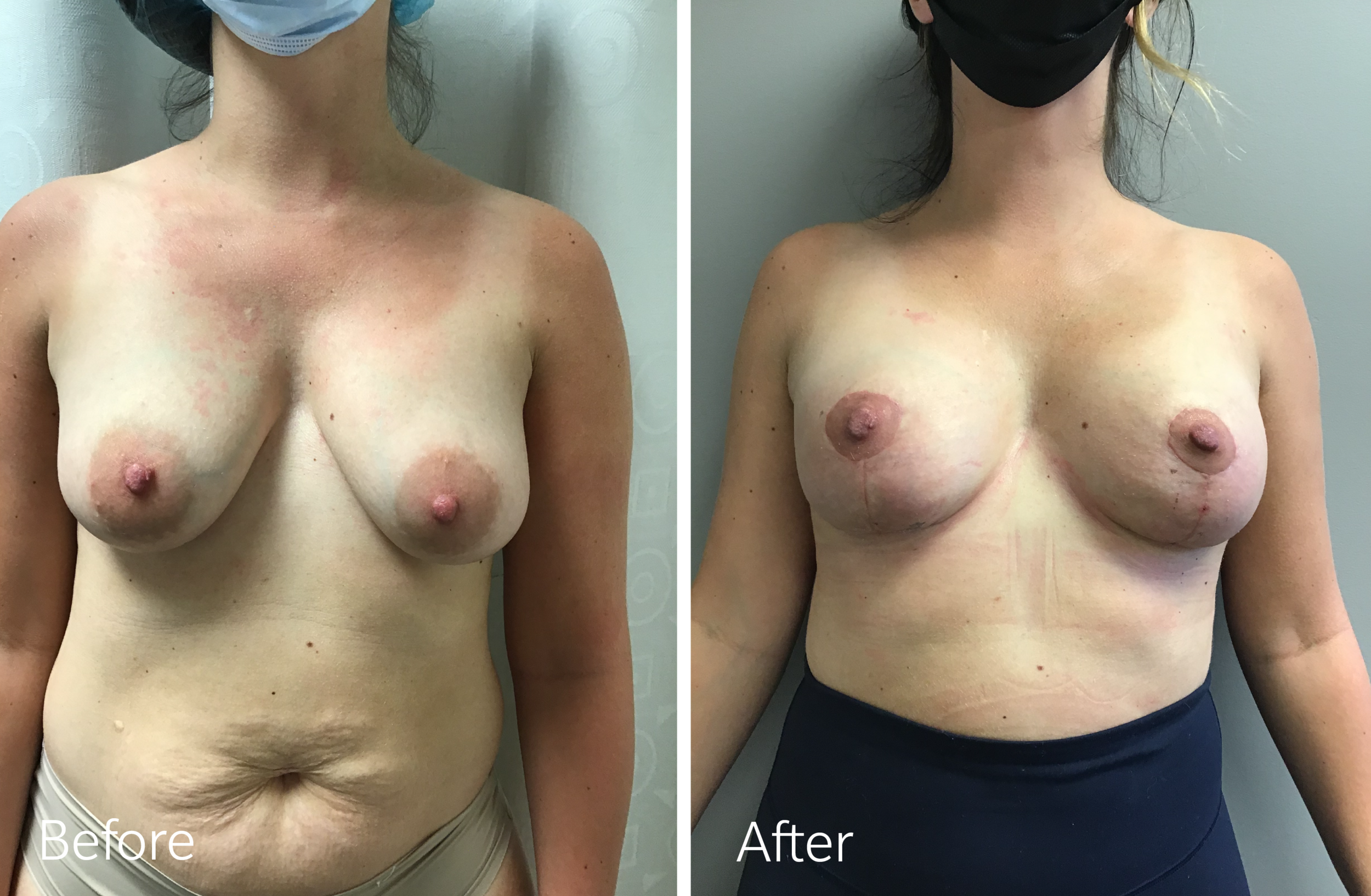 Breast lift and augmentation surgery by Dr. Steven Porto