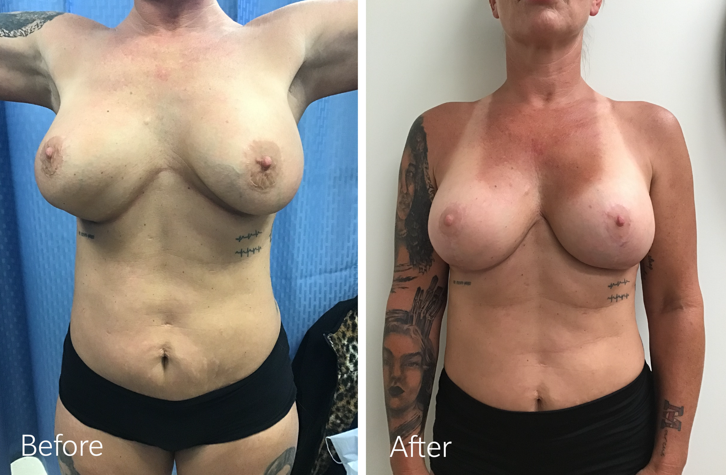 Breast lift and augmentation surgery by Dr. Steven Porto