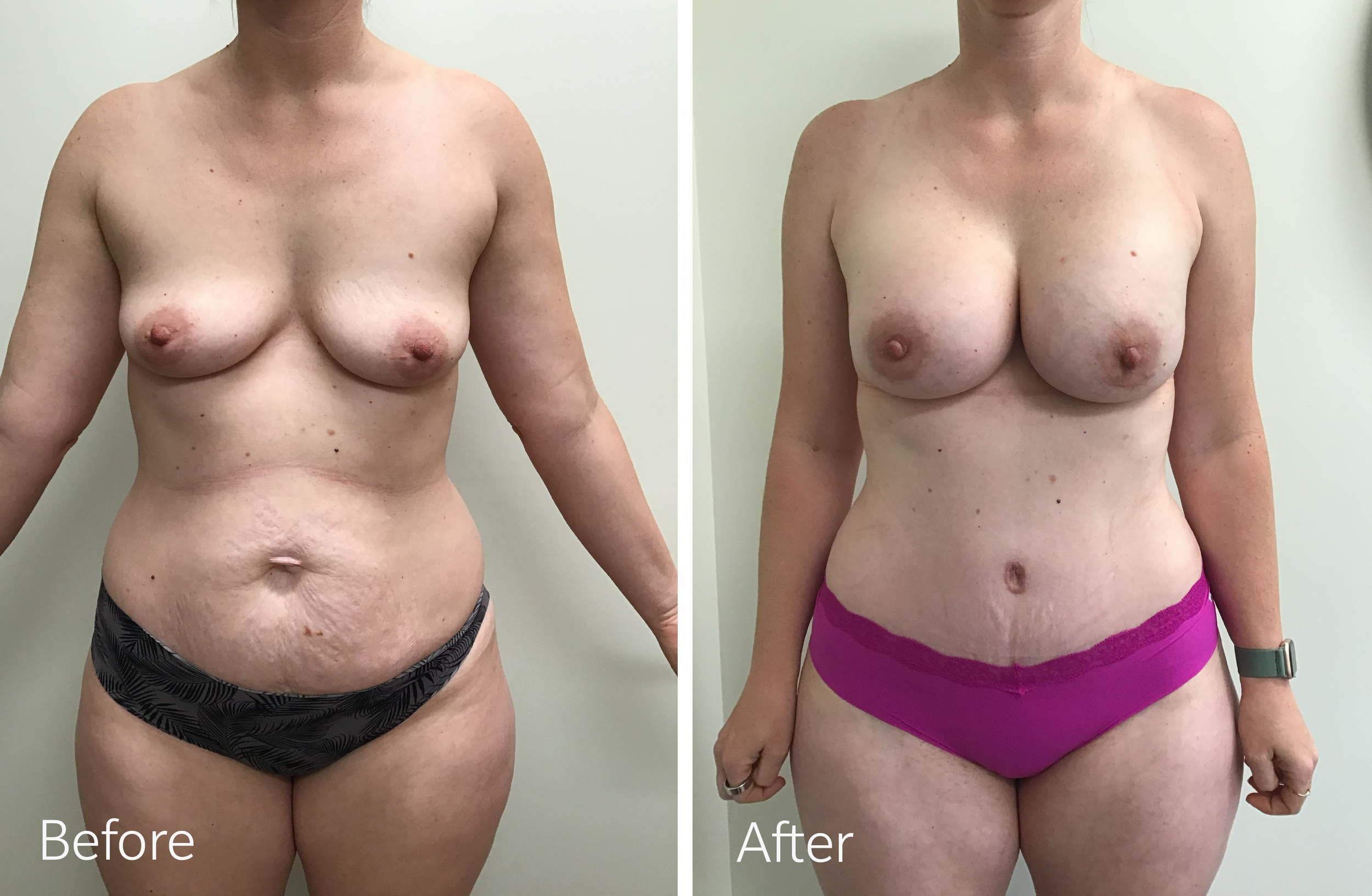 Tummy tuck, breast lift and implant surgery by Dr. Steven Porto, Board Certified Plastic Surgeon in Indianapolis, Indiana