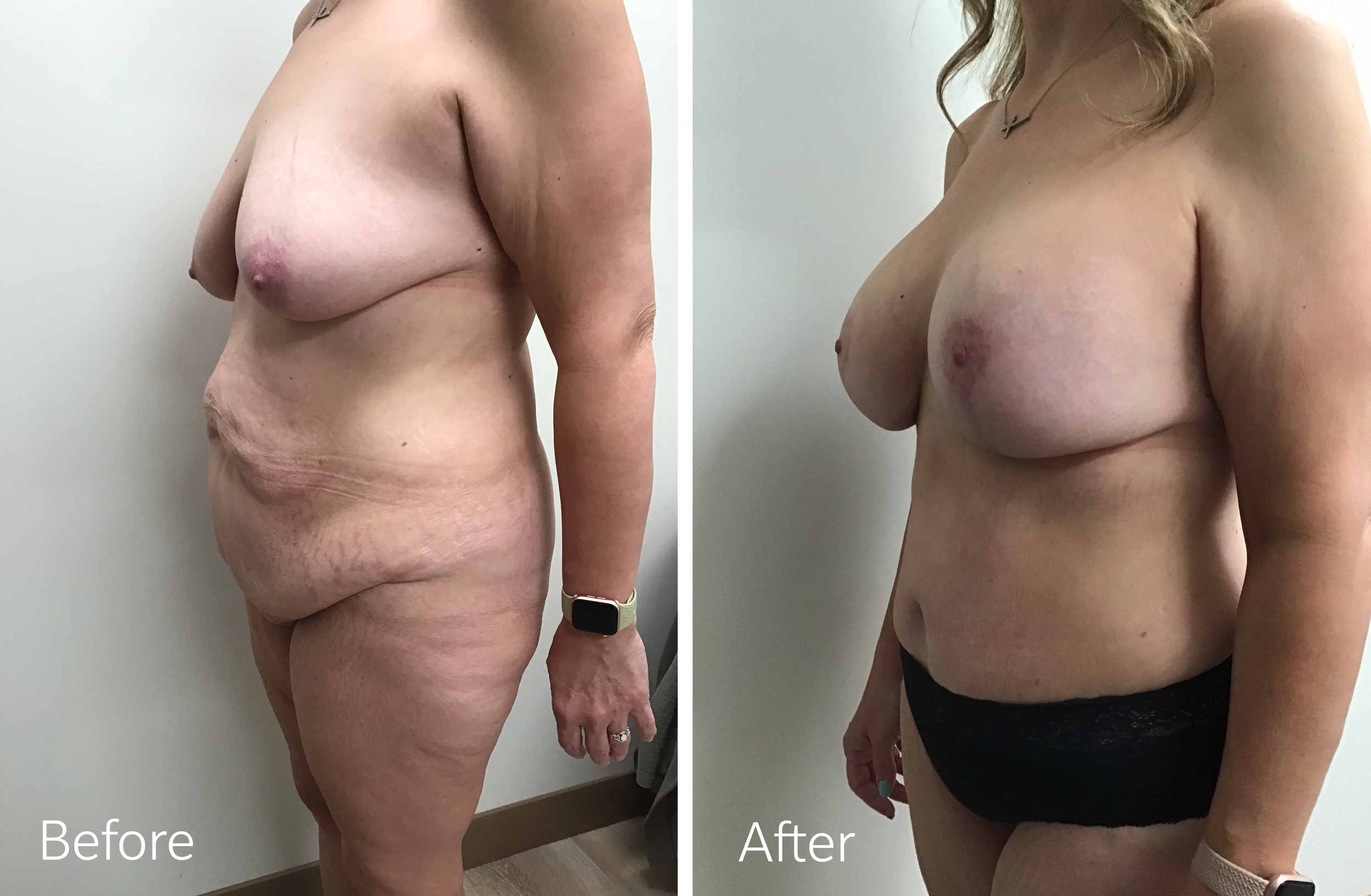 Tummy tuck, breast lift and implant surgery by Dr. Steven Porto, Board Certified Plastic Surgeon in Indianapolis, Indiana