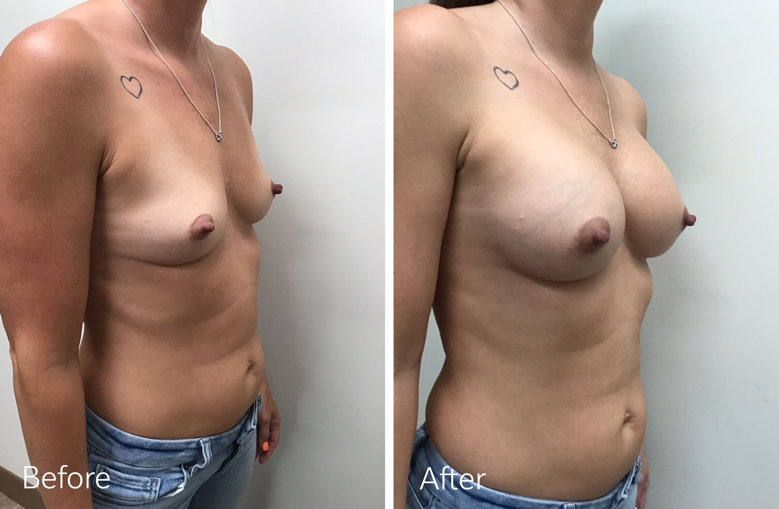 Dr. Steven Porto Indianapolis Indiana Plastic Surgeon Breast Augmentation Surgery