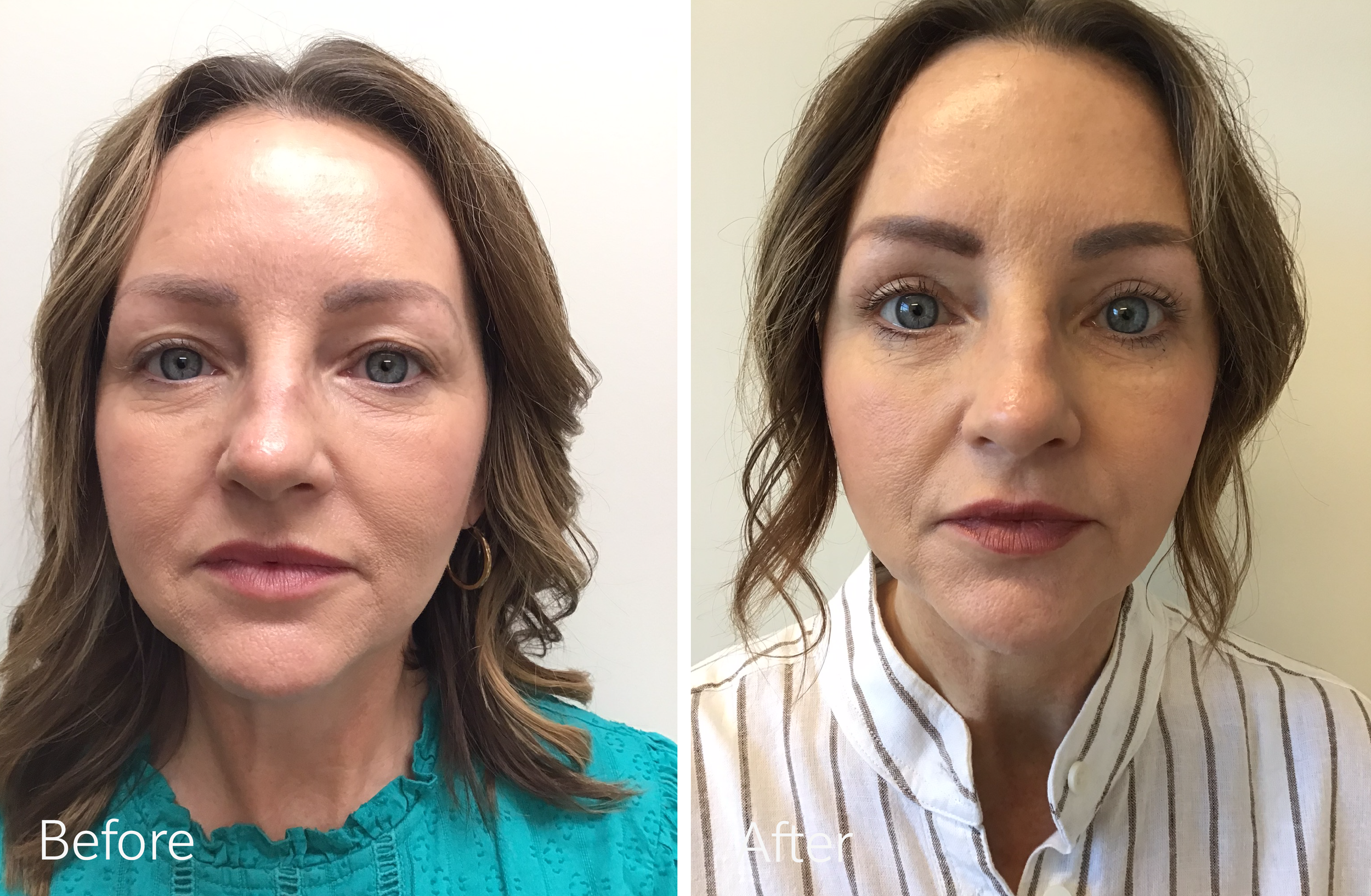 brunette woman with blue eyes before and after of an upper eye lid surgery to enhance her natural beauty