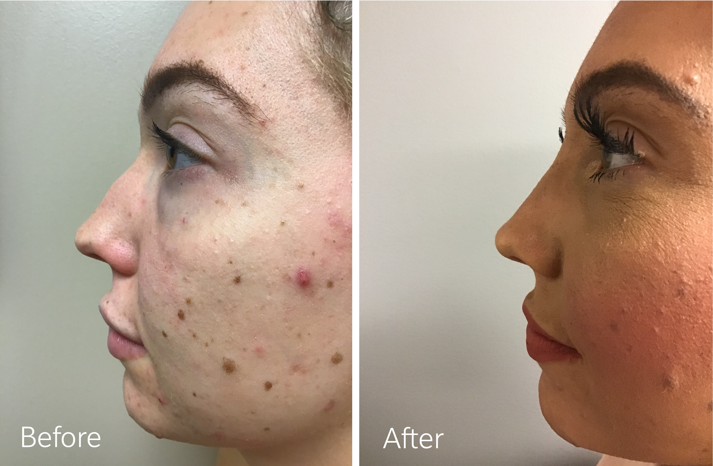 Rhinoplasty surgery by Dr. Steven Porto, Board Certified Plastic Surgeon in Indianapolis, Indiana