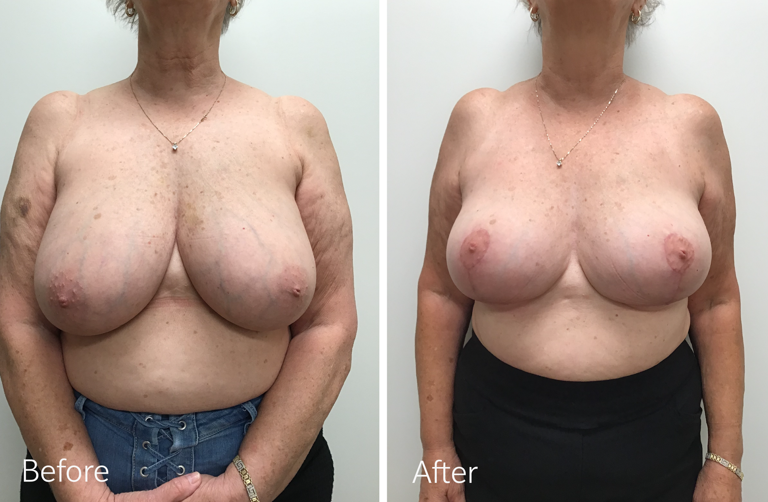 Breast reduction surgery by Dr. Steven Porto