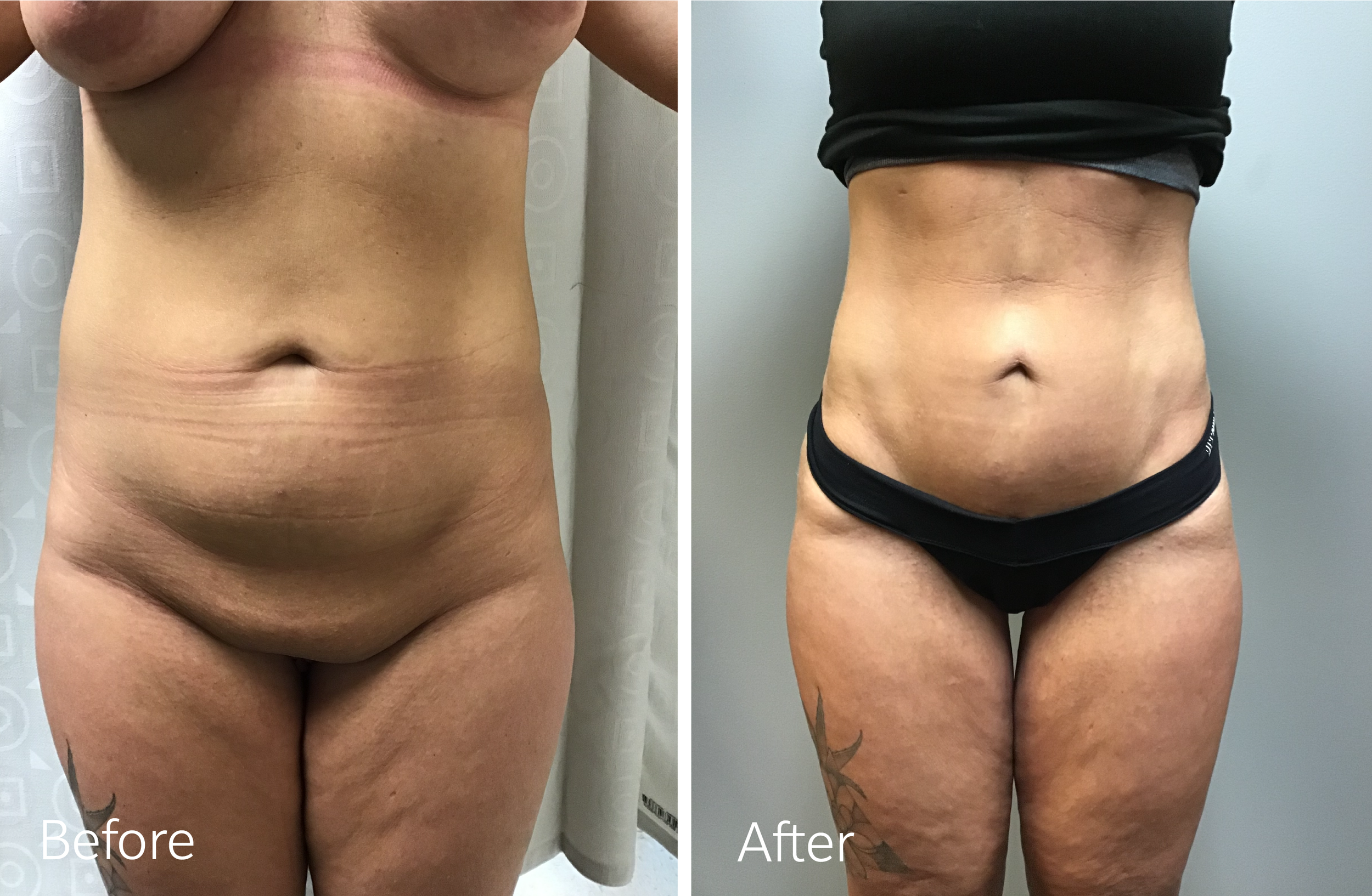 Mini TummyMini Tummy Tuck by Dr. Steven Porto, Board Certified Plastic Surgeon in Indianapolis, Indiana