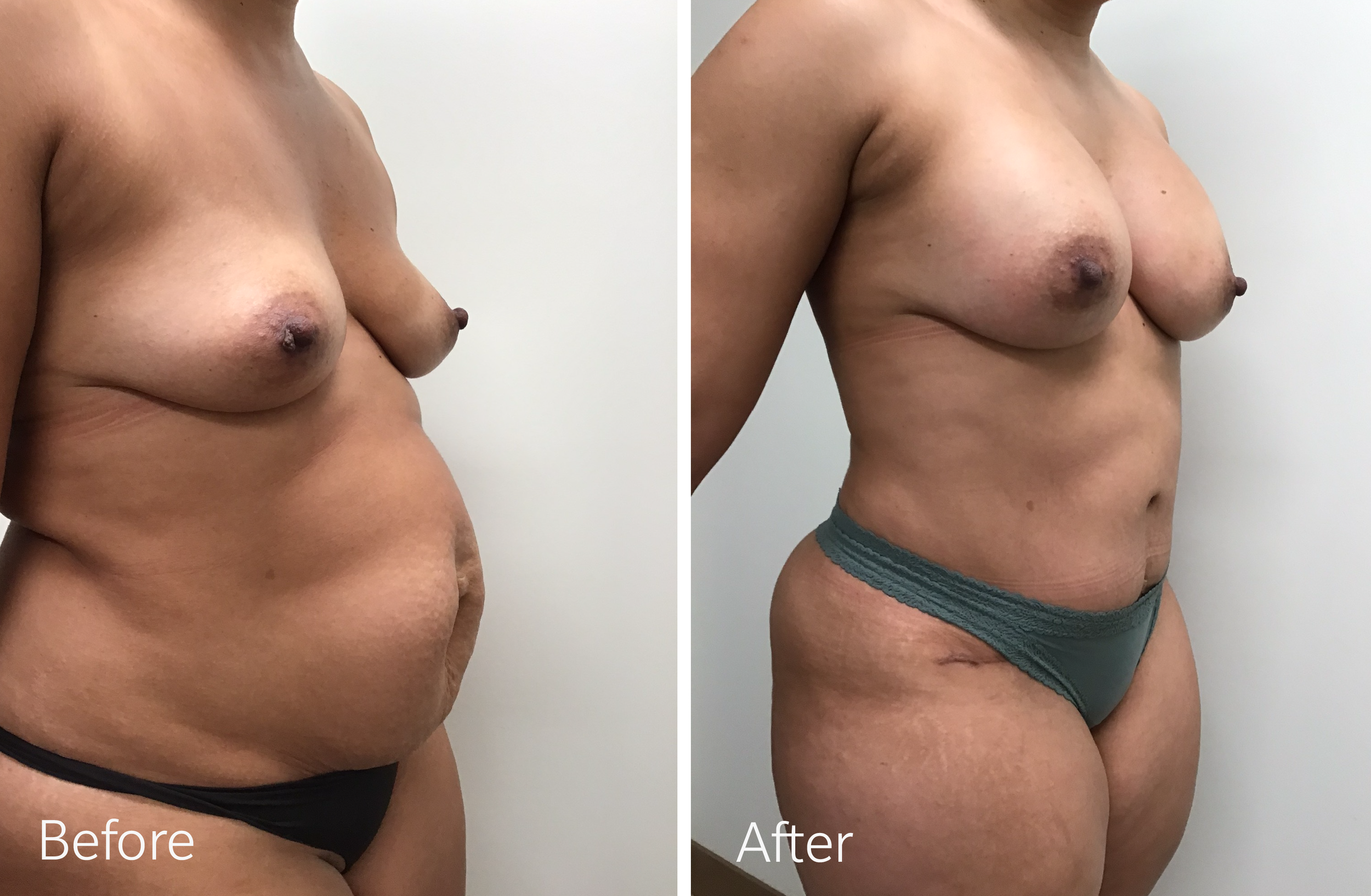 Tummy tuck, breast lift and implant surgery by Dr. Steven Porto, Board Certified Plastic Surgeon in Indianapolis, Indiana