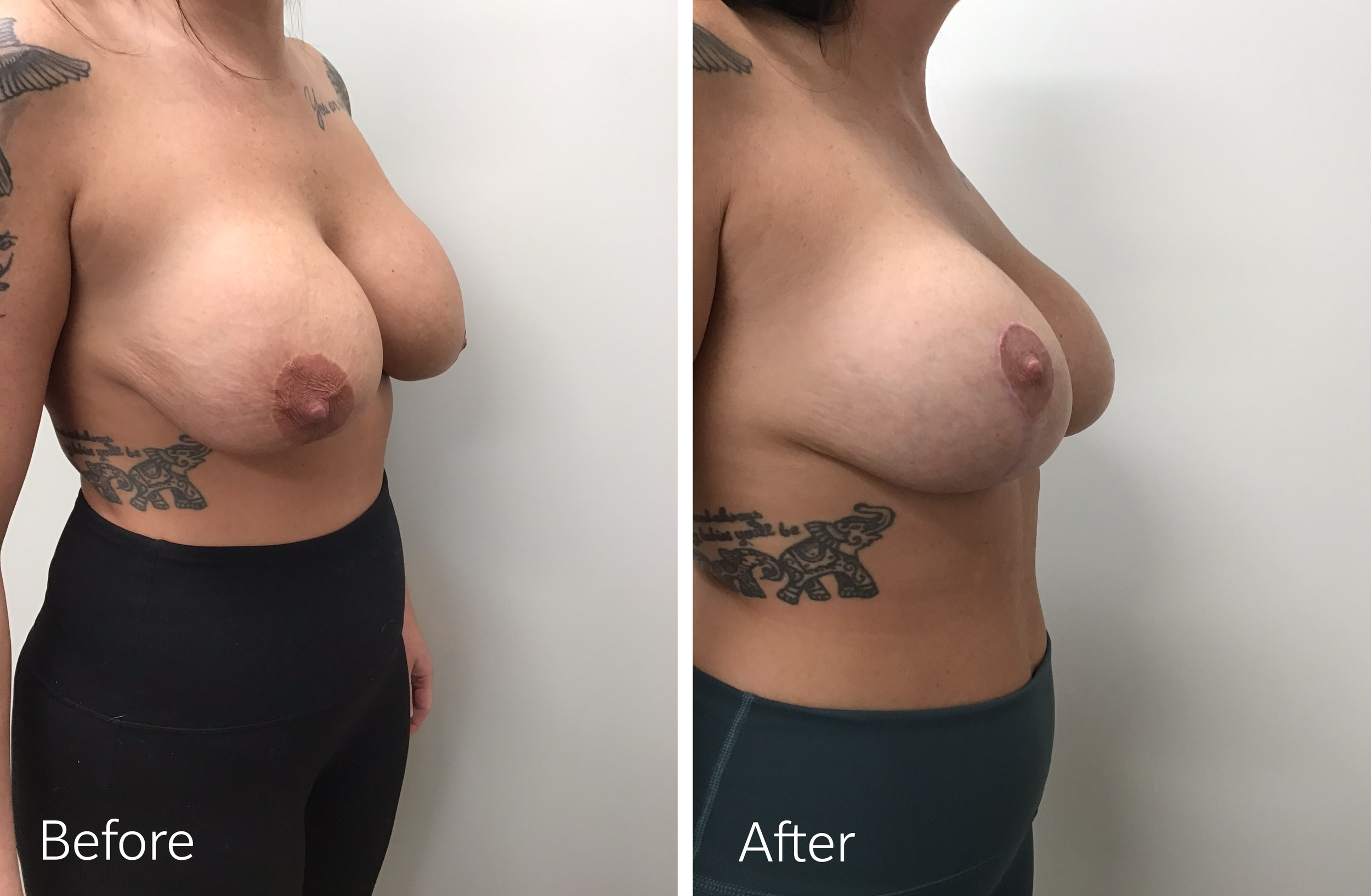Breast Lift Surgery by Dr. Steven Porto, Plastic Surgeon in Fishers, Indiana