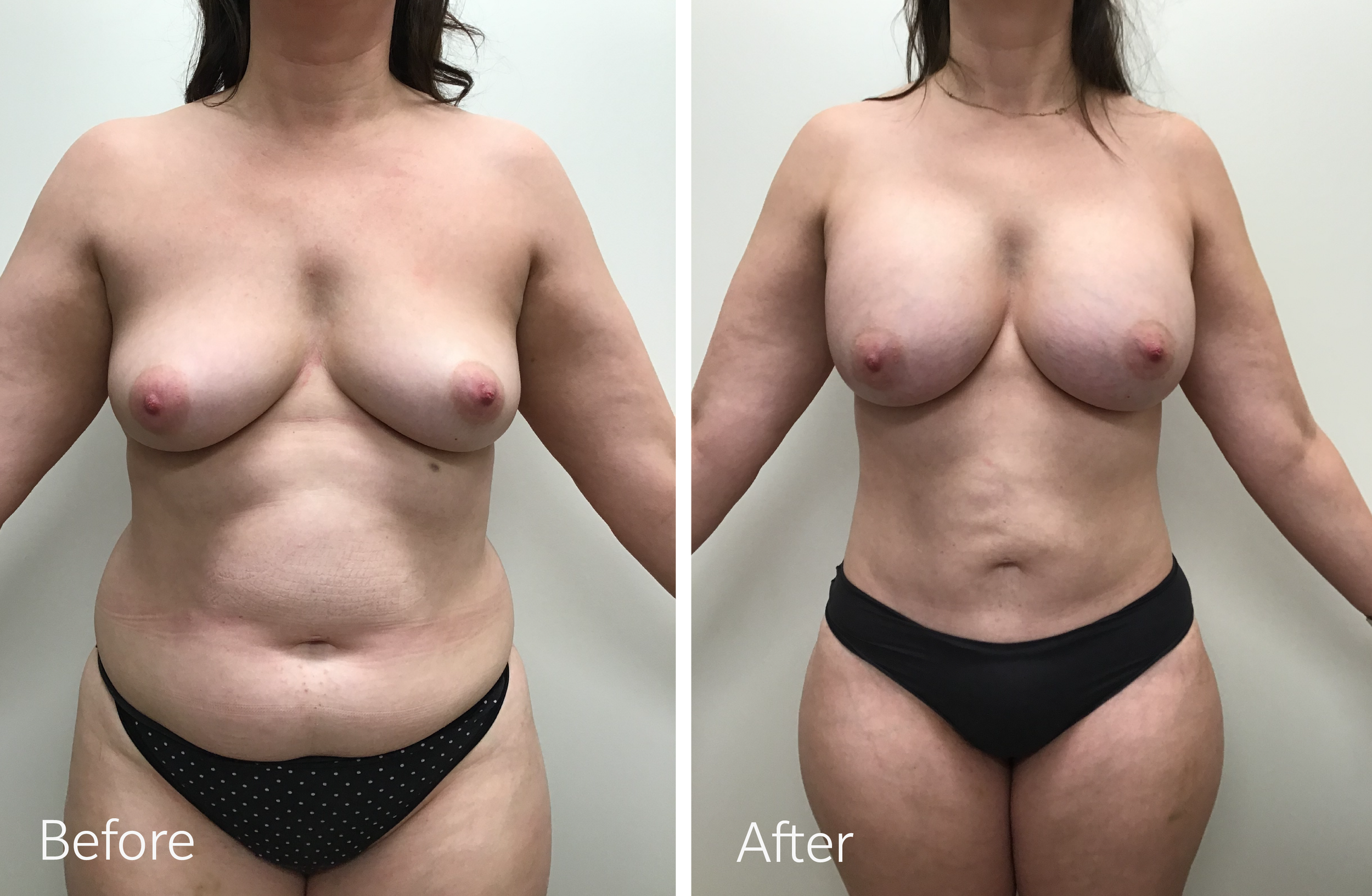 Tummy tuck, breast lift and implant surgery by Dr. Steven Porto, Board Certified Plastic Surgeon in Indianapolis, Indiana