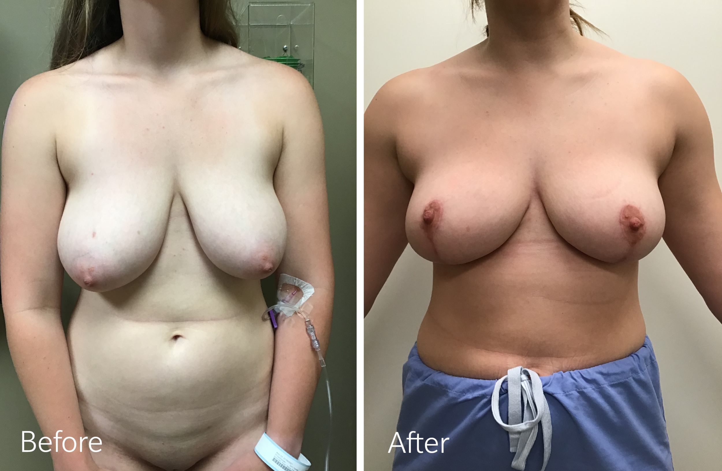 Breast reduction surgery by Dr. Steven Porto