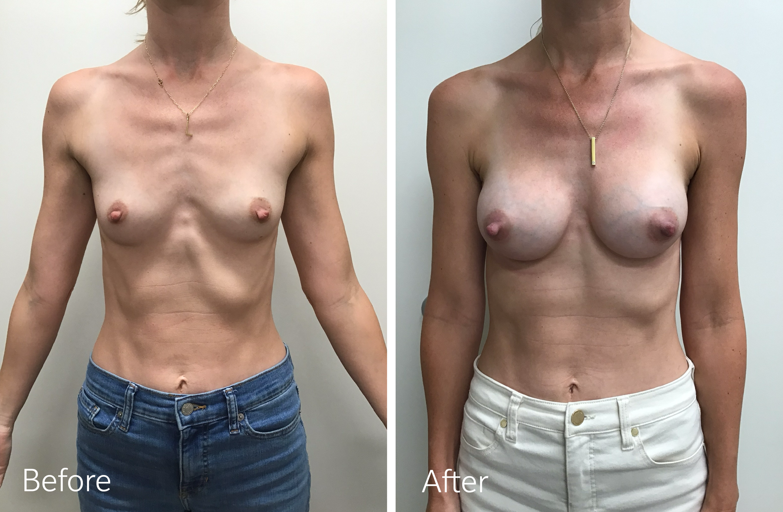 Breast Augmentation Surgery with 240cc Implants by Dr. Steven Porto