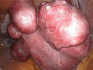 Laparoscopic view of a uterus studded with fibroids