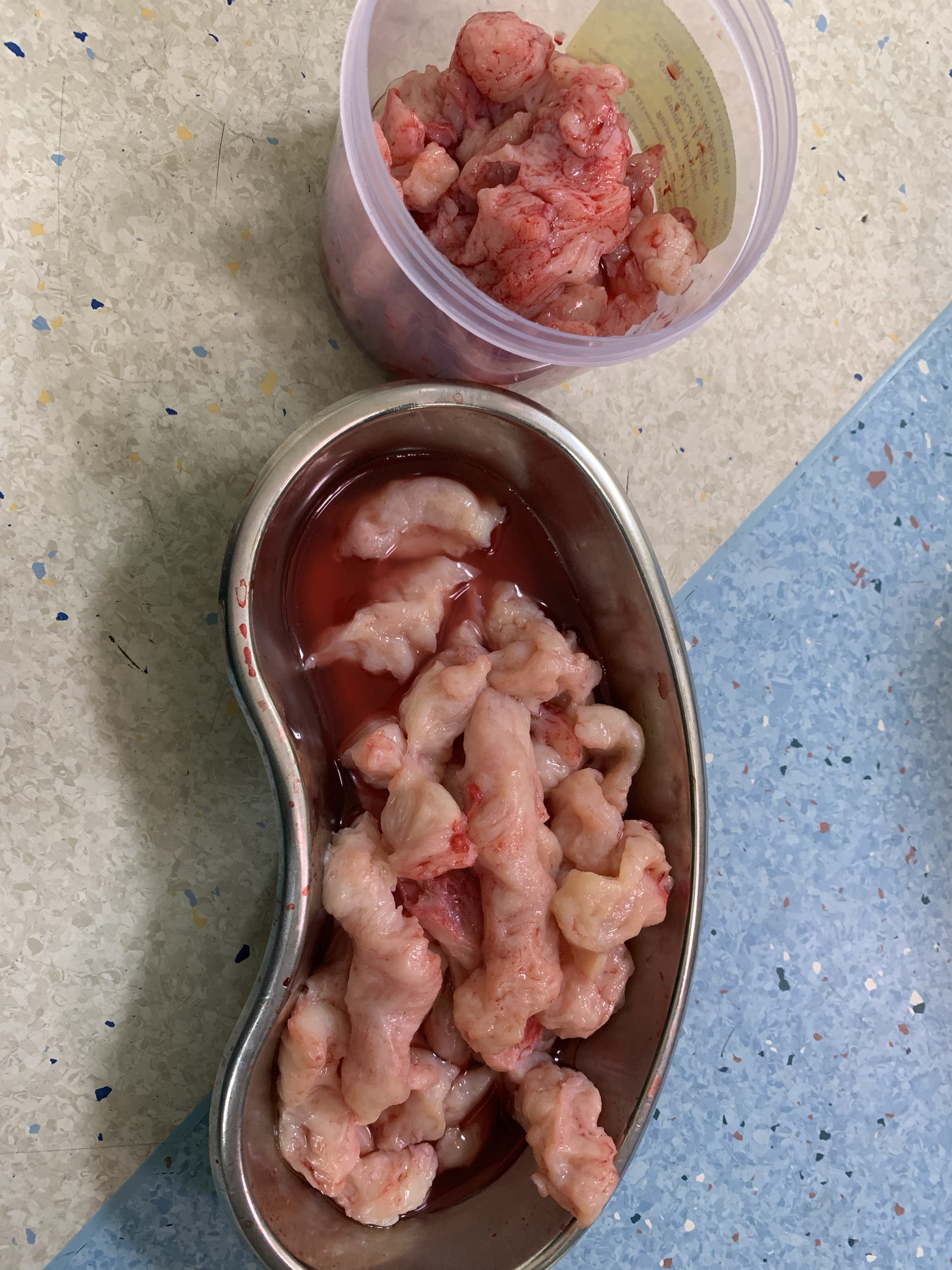 A large fibroid removed in strips