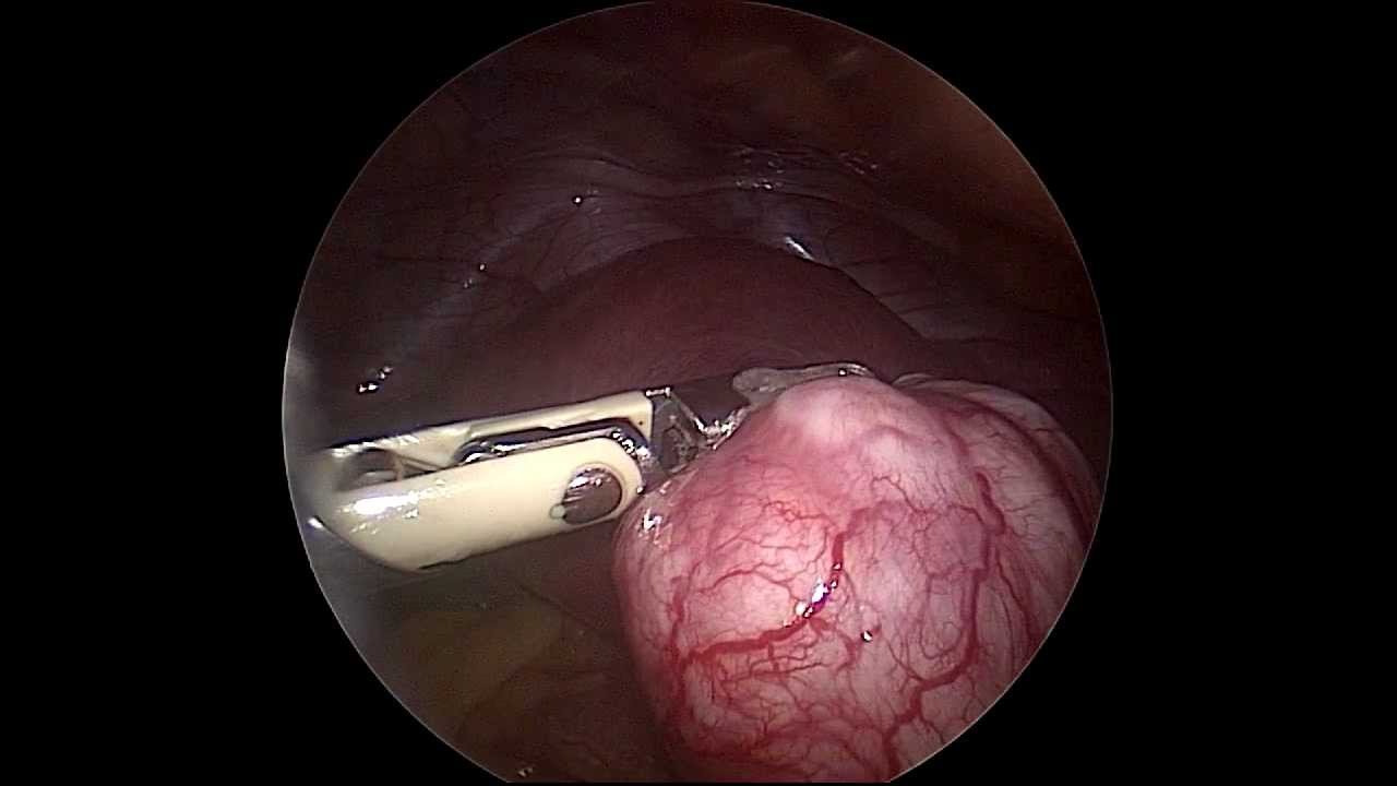 A subserous fibroid