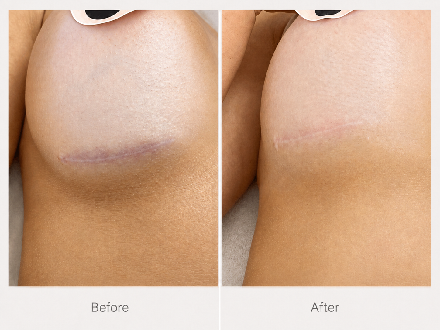Scar revision before and after for web.png
