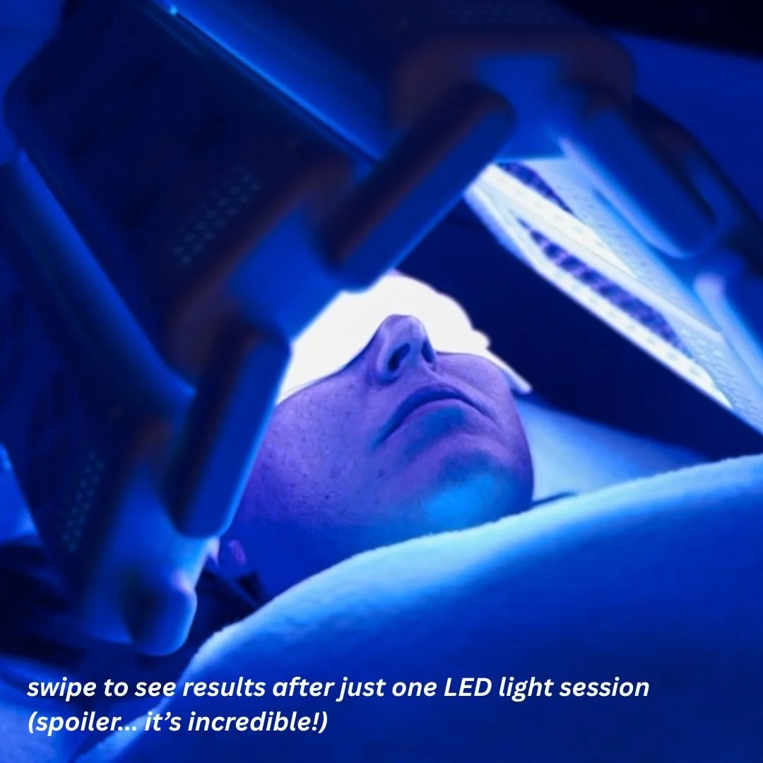 what if we told you this was from just one LED light therapy session? 🤯

amazing real results for our client using a combination of blue and red light. blue light works to target acne-causing bacteria as it reduces sebaceous activity, while red ligh