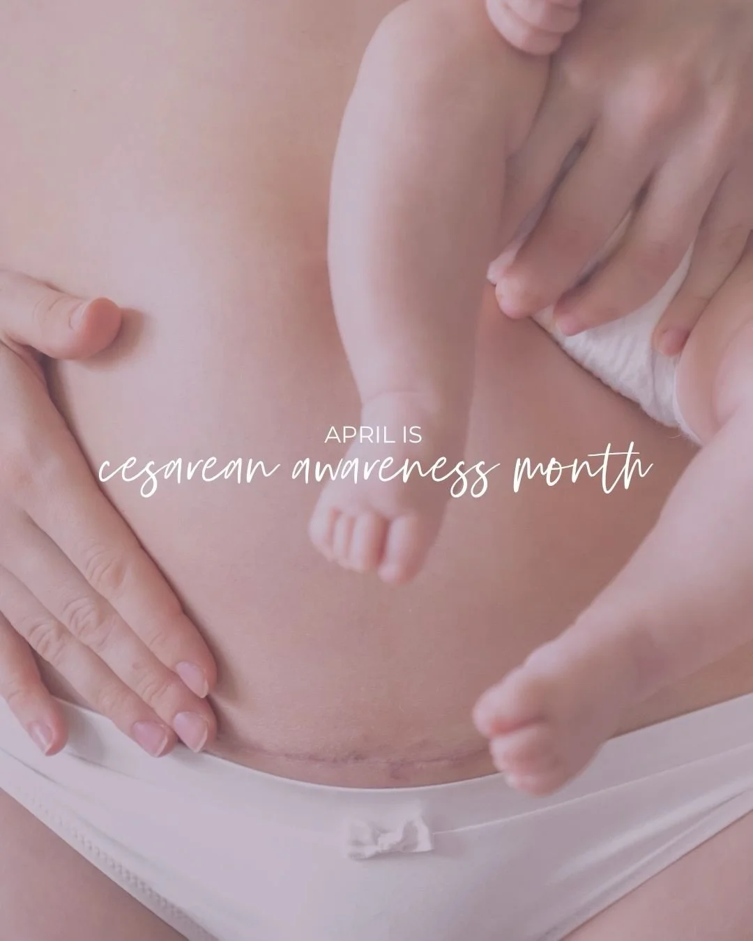 April is Cesarean Awareness Month 🤍

With #cesarean birth being the most common surgical procedure in the U.S. (accounting for about 1 in 3 births) this month is focused on education, understanding, and improving the overall patient experience.

A c