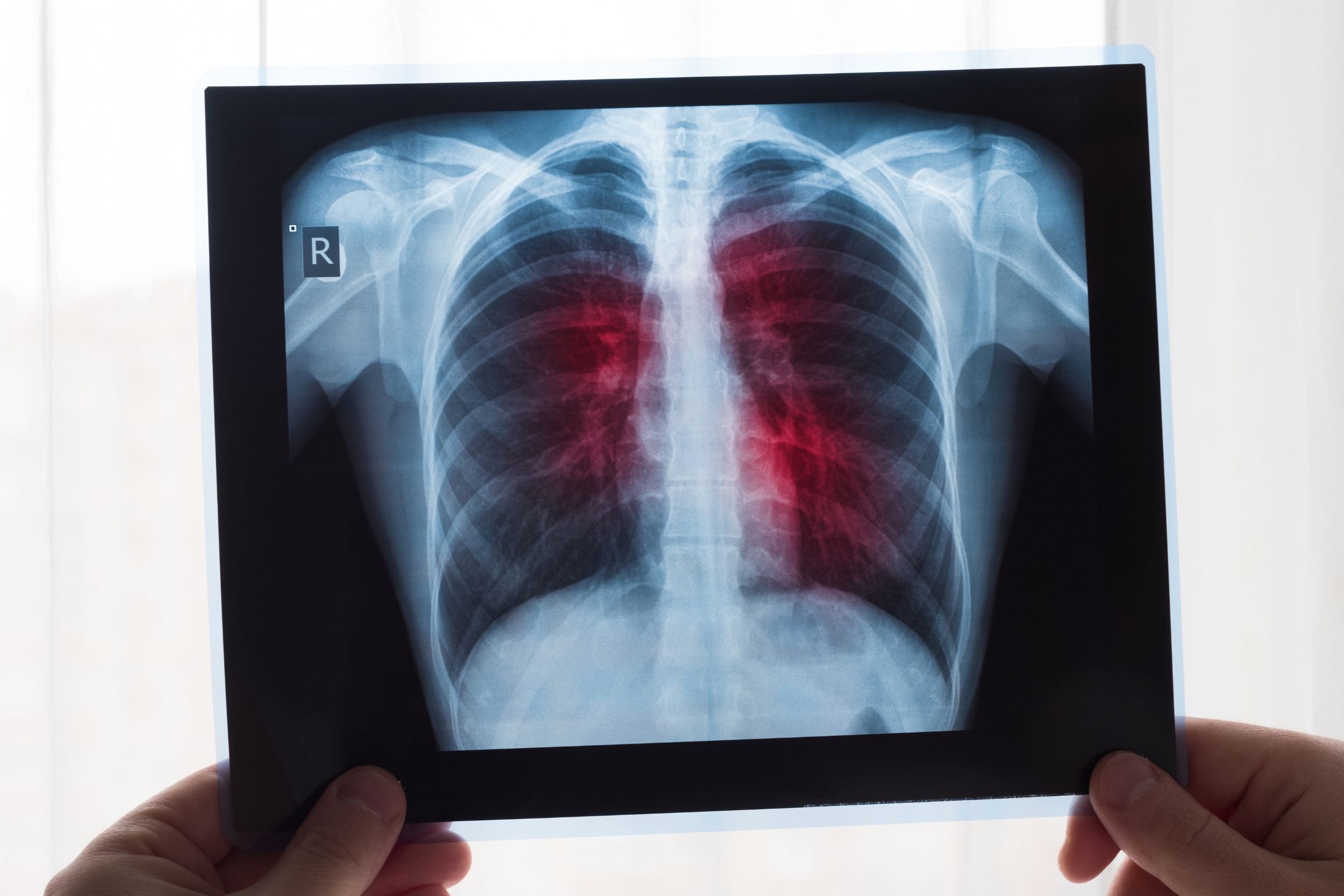 A physician holds up a chest X-ray to the light. Red areas in the lungs indicate abnormalities.