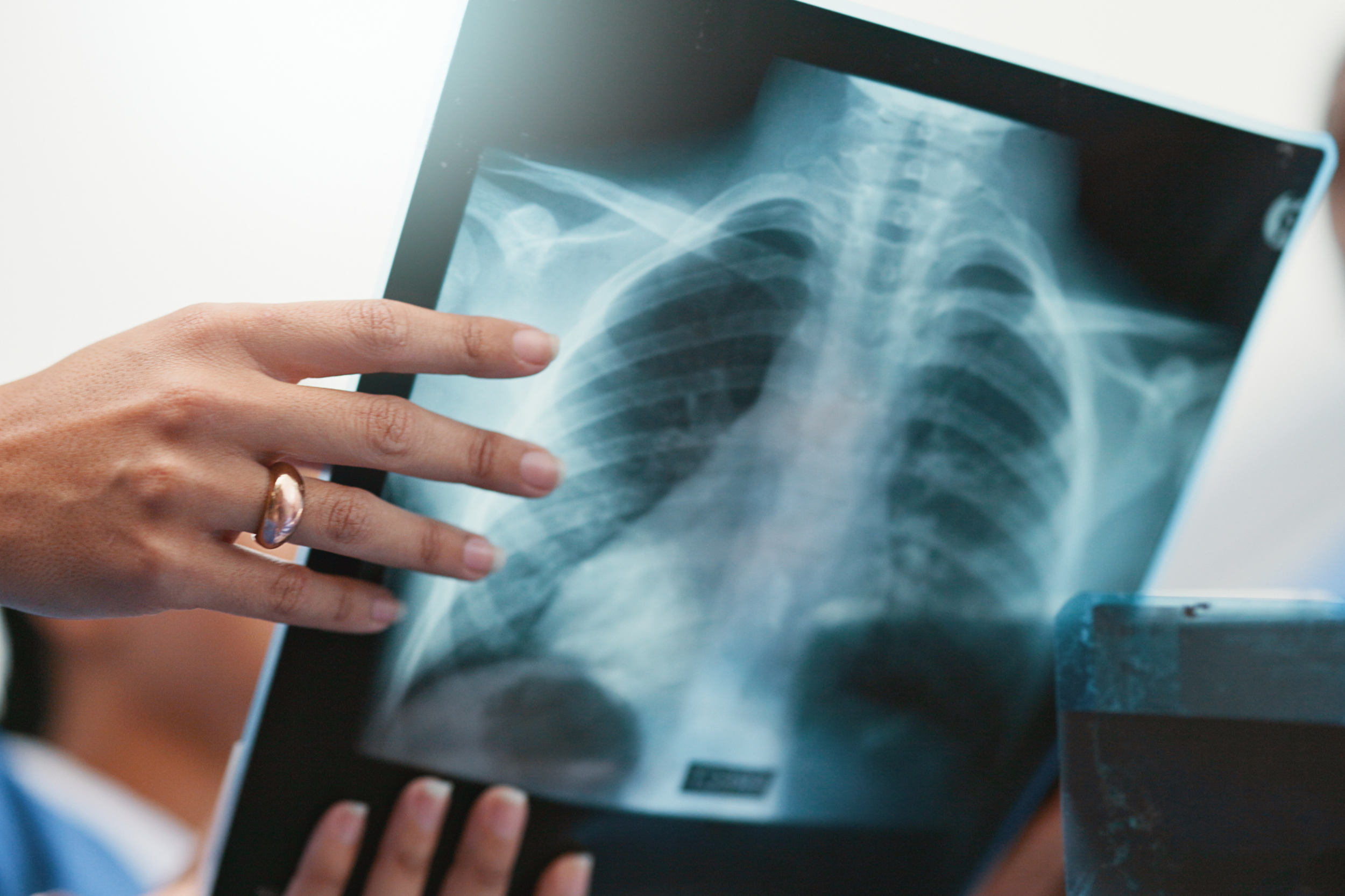 What to Do If You Have an Abnormal Chest X-Ray or TB Screening After an IME