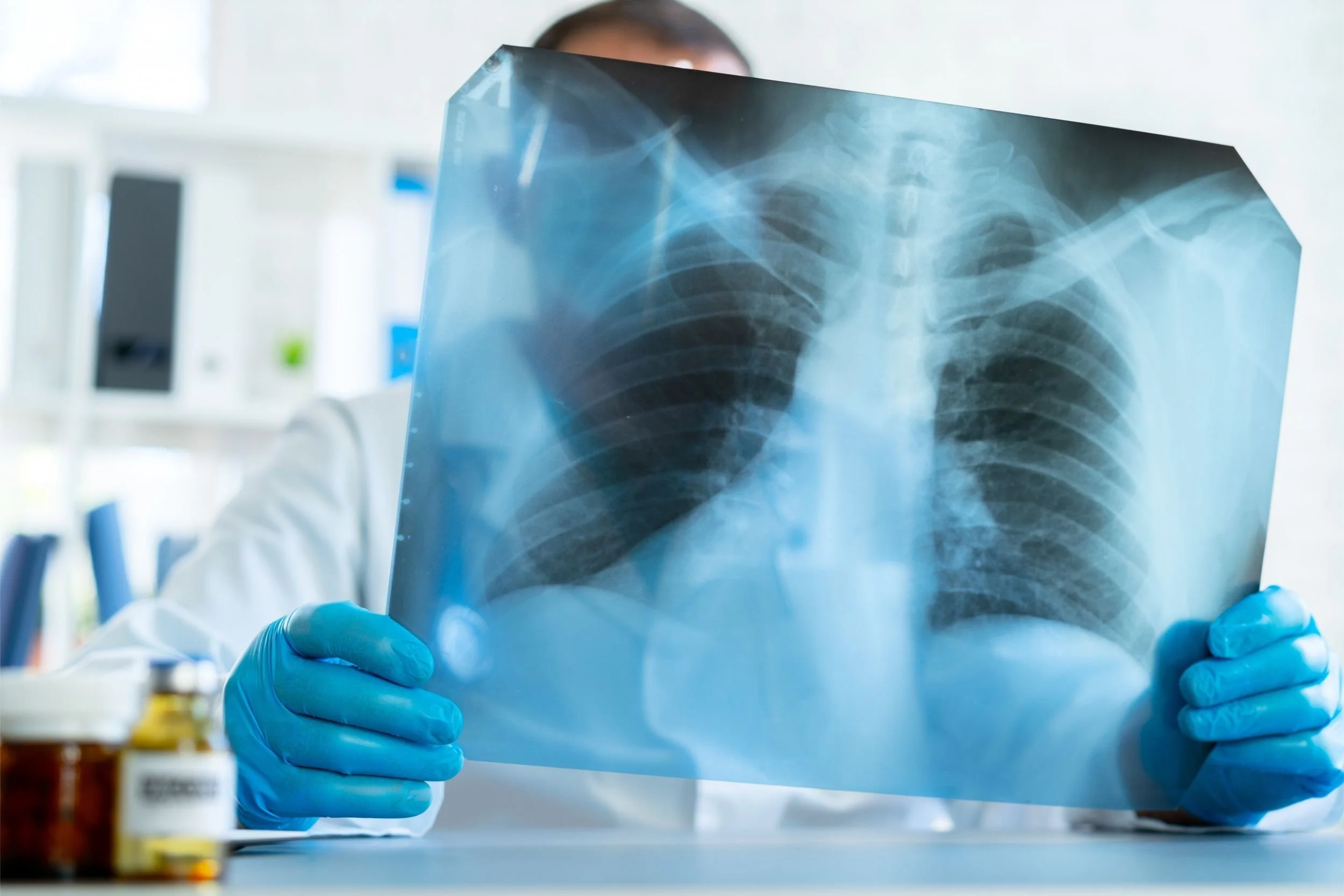 A doctor wearing blue gloves reviews a patient's lung X-ray in a brightly lit office.
