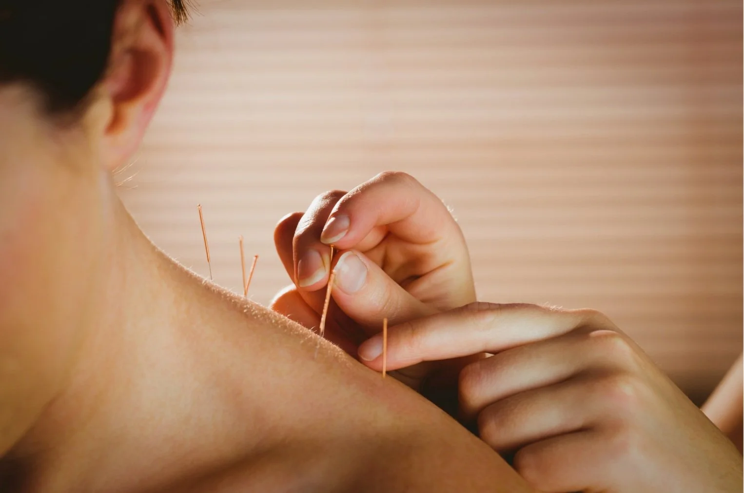 Acupuncture.jpg