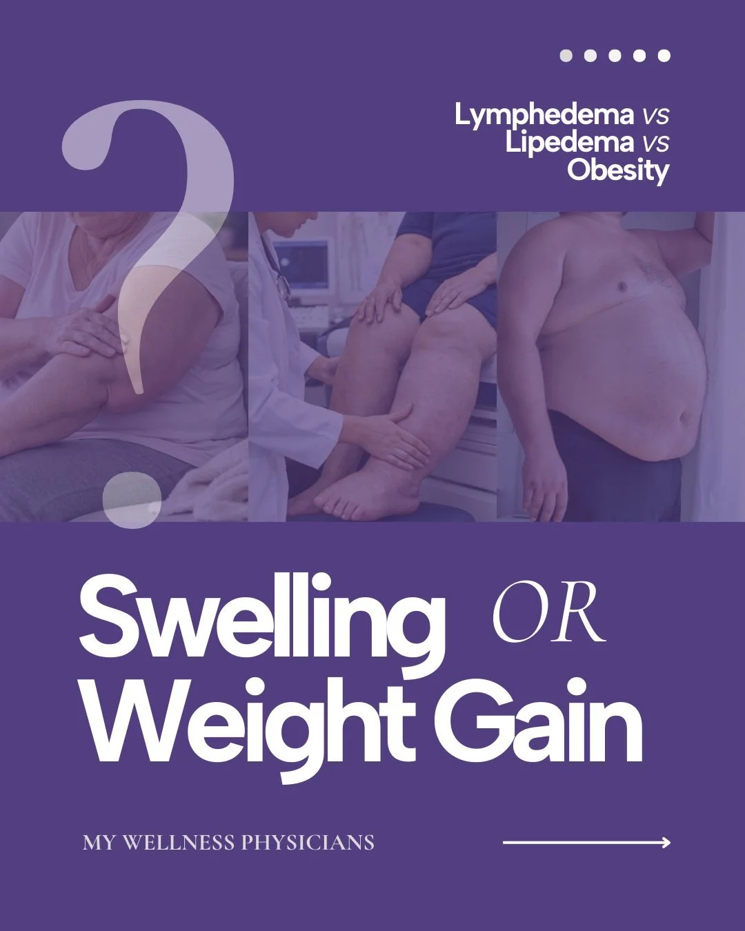 Swelling isn&rsquo;t always weight gain.
And weight gain isn&rsquo;t always the problem.

Lymphedema, lipedema, and obesity can look similar&mdash;but they&rsquo;re driven by very different causes and need very different approaches.

&bull; One is a 