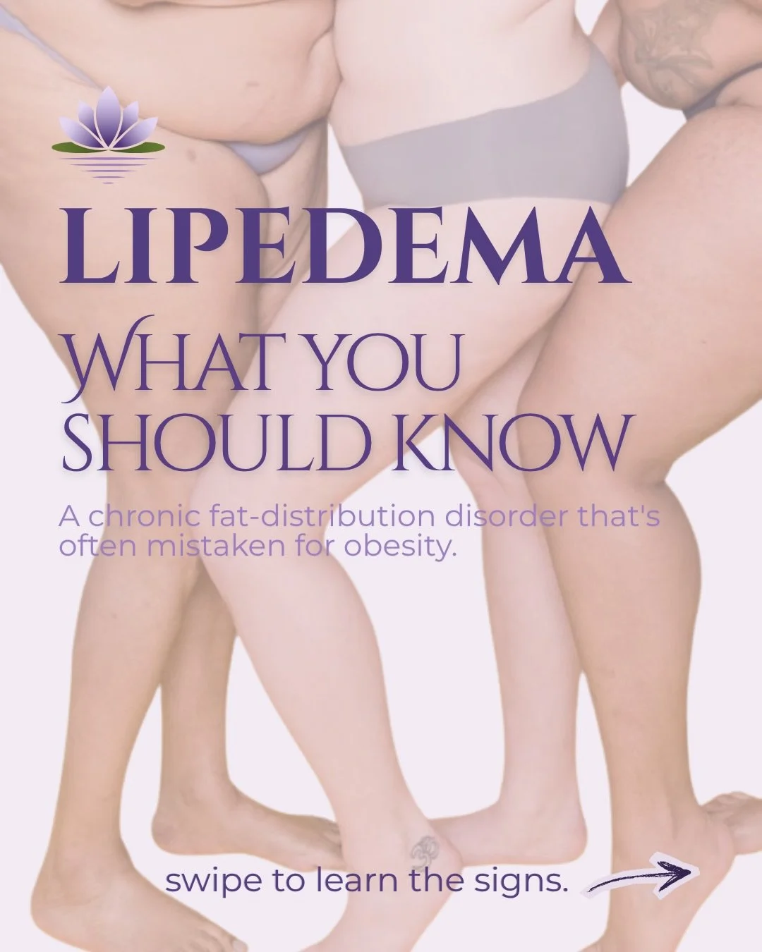 Lipedema is more than &ldquo;weight gain.&rdquo; It&rsquo;s a chronic disorder of fat distribution that often affects the hips, thighs, calves, and sometimes the arms, while sparing the hands and feet.

Common signs include:
✅ symmetrical swelling 
✅