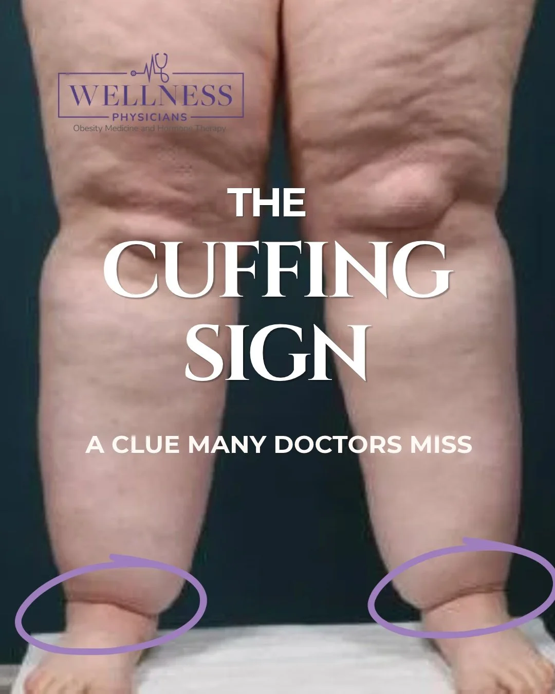Swipe to see what "cuffing" actually looks like.

If your ankles have always looked slimmer than your calves, like your leg just stops, you're not imagining it. That's the cuffing sign, one of the clearest visual clues of lipedema.

Lipedem