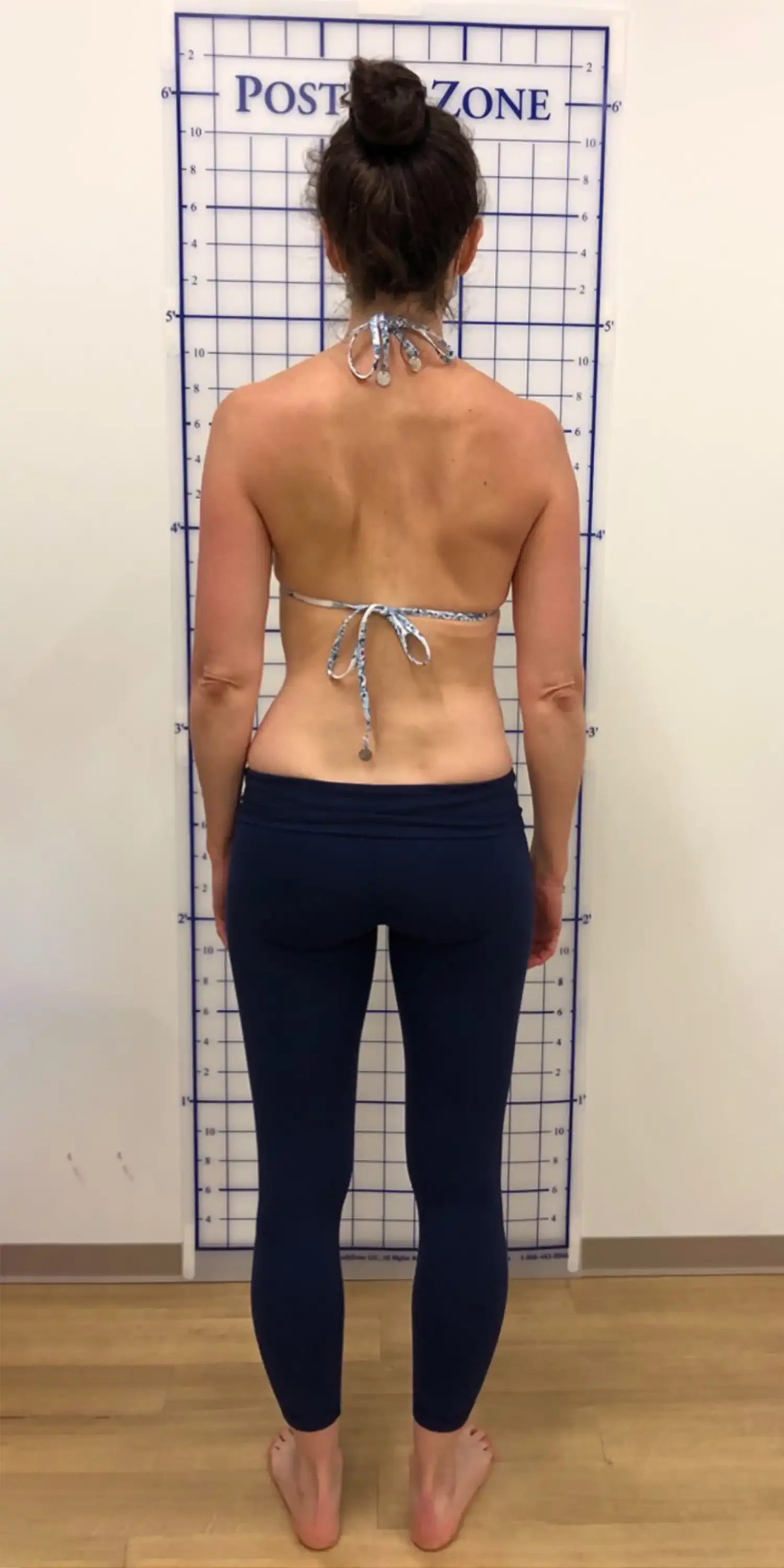 before scoliosis transformation