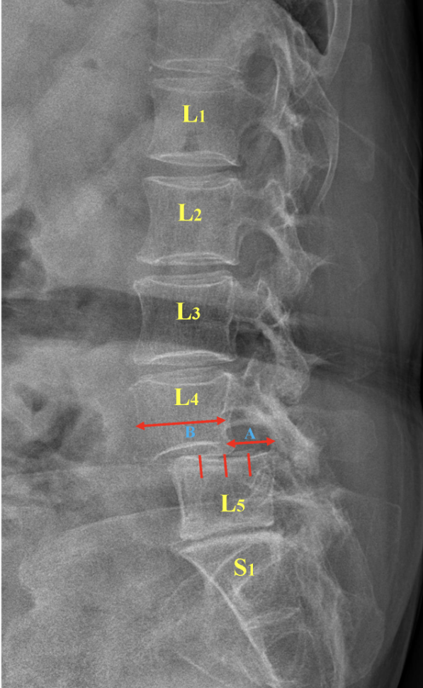 Listesis What Is Autofusion Of The Spine