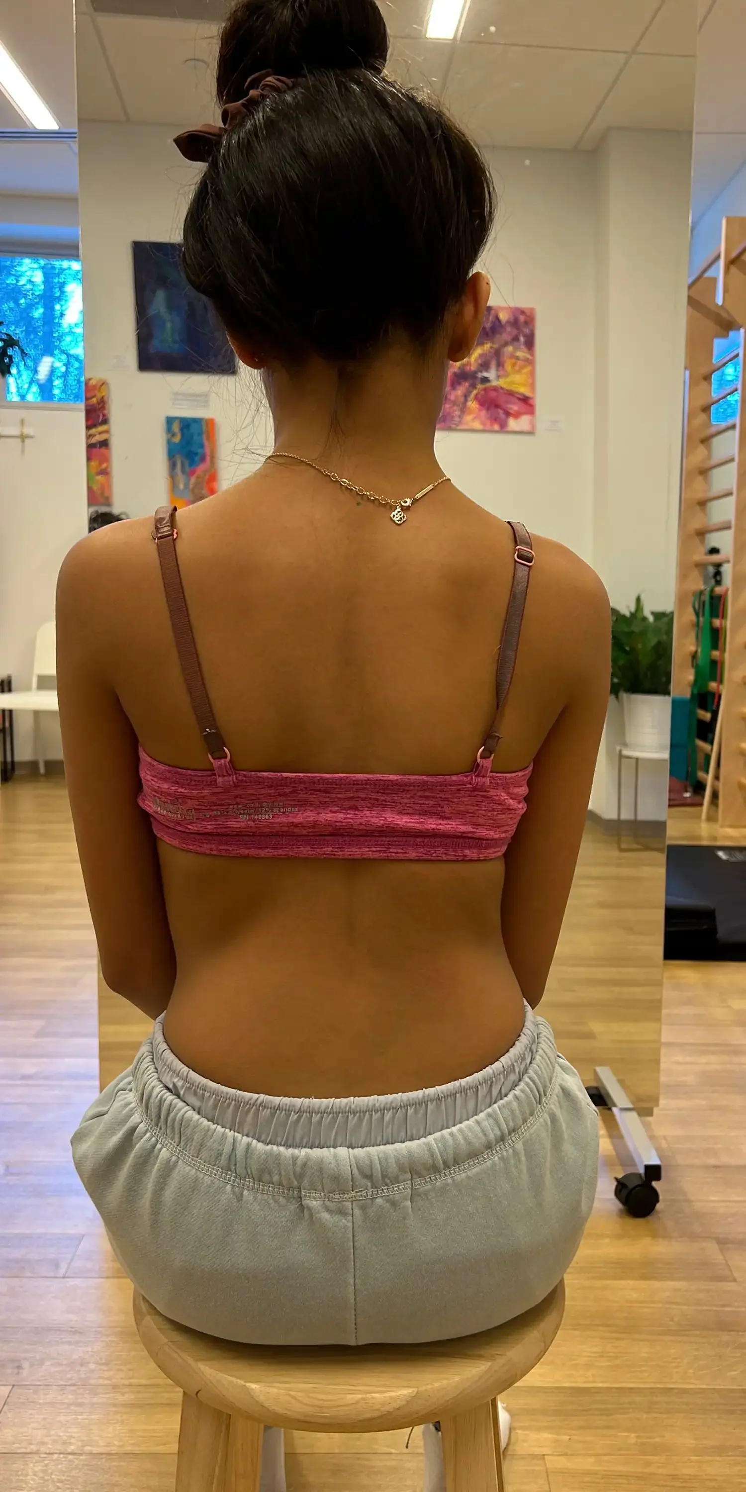 11 yr old after scoliosis transformation