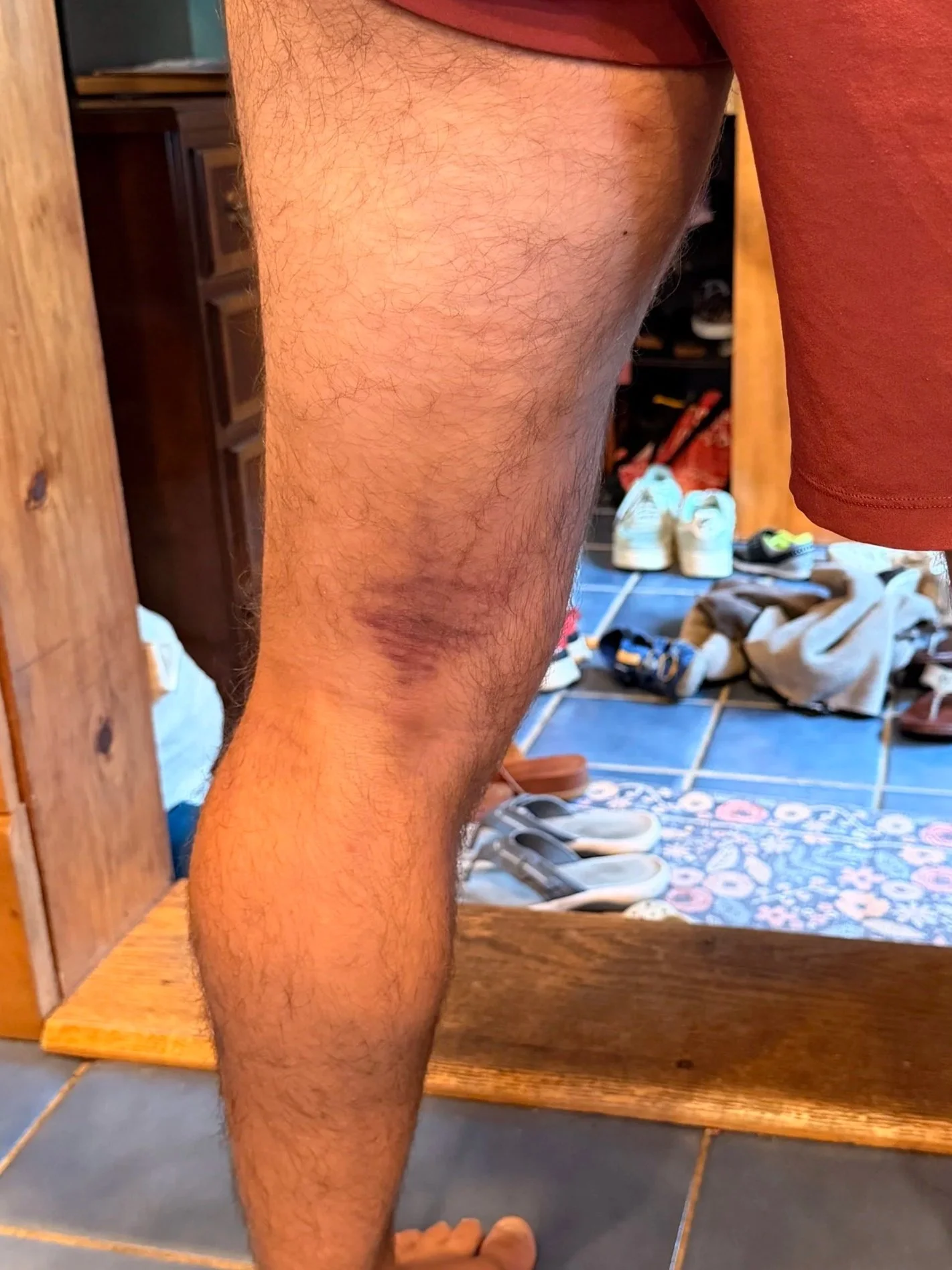 I Tore My Hamstring