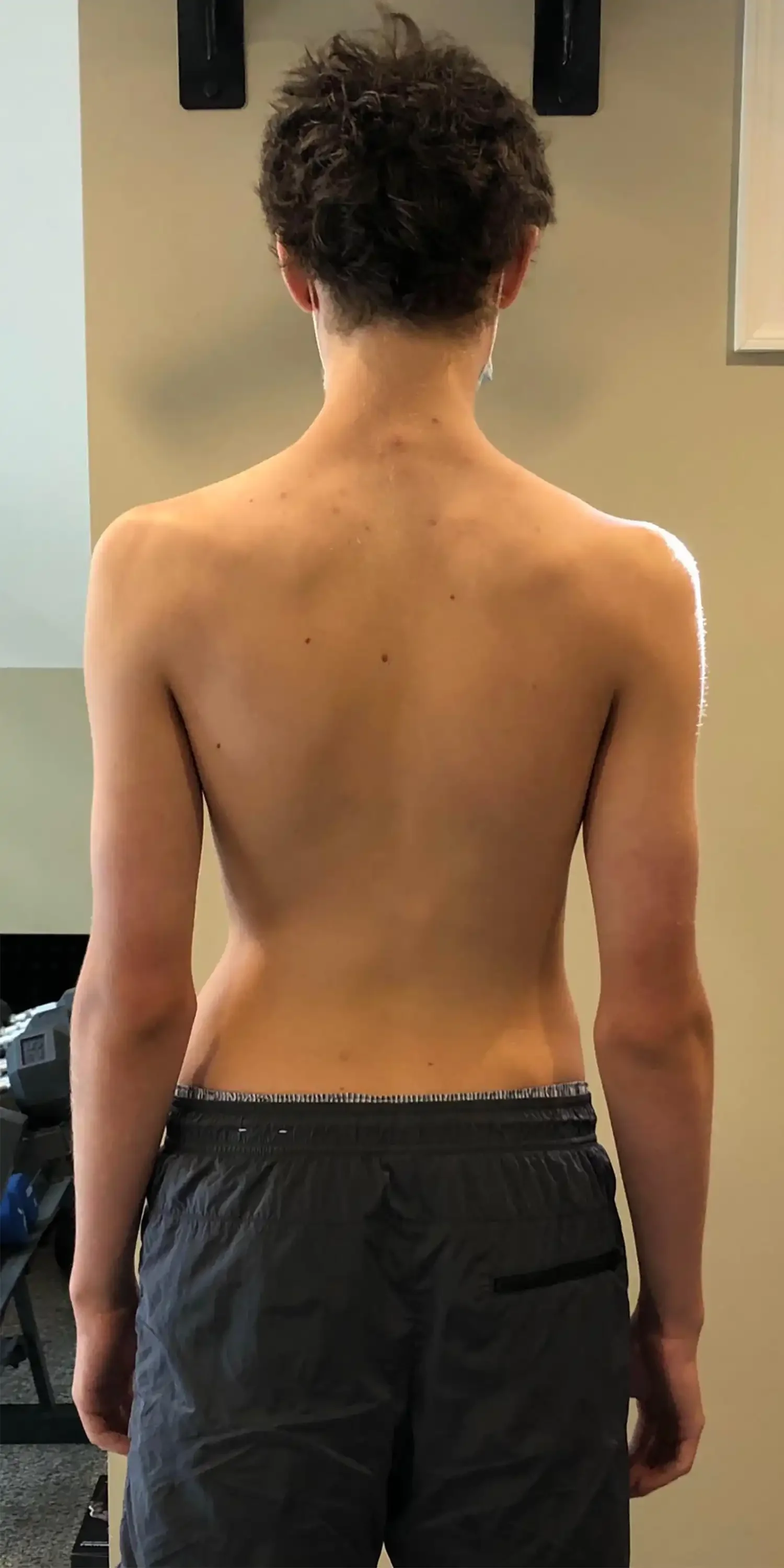 before scoliosis transformation