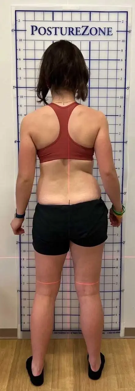 before scoliosis transformation