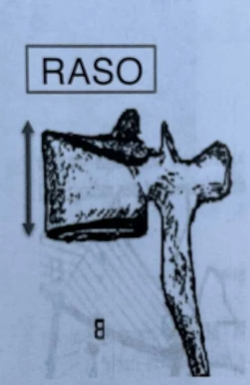 What Is A Raso Chain Pattern What is Adolescent Idiopathic Scoliosis? | Schroth DC