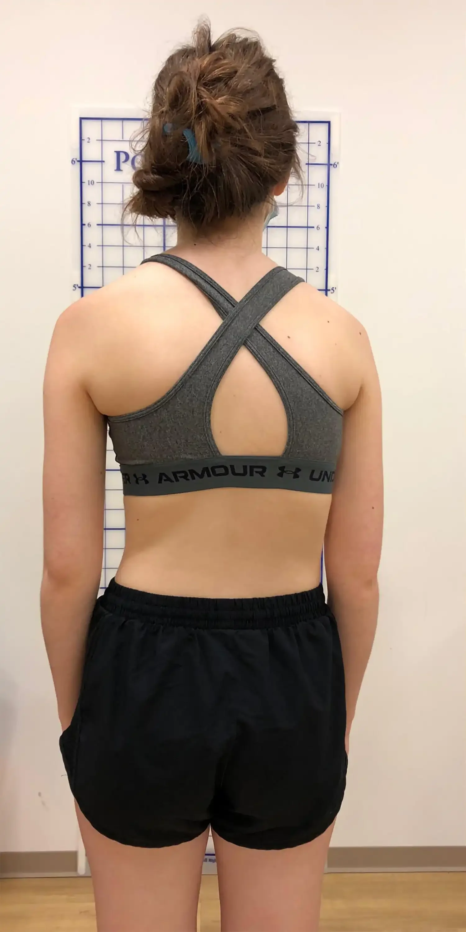 before scoliosis transformation