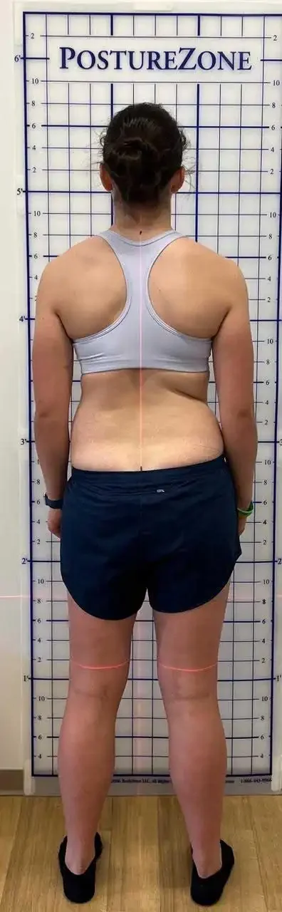 after scoliosis transformation
