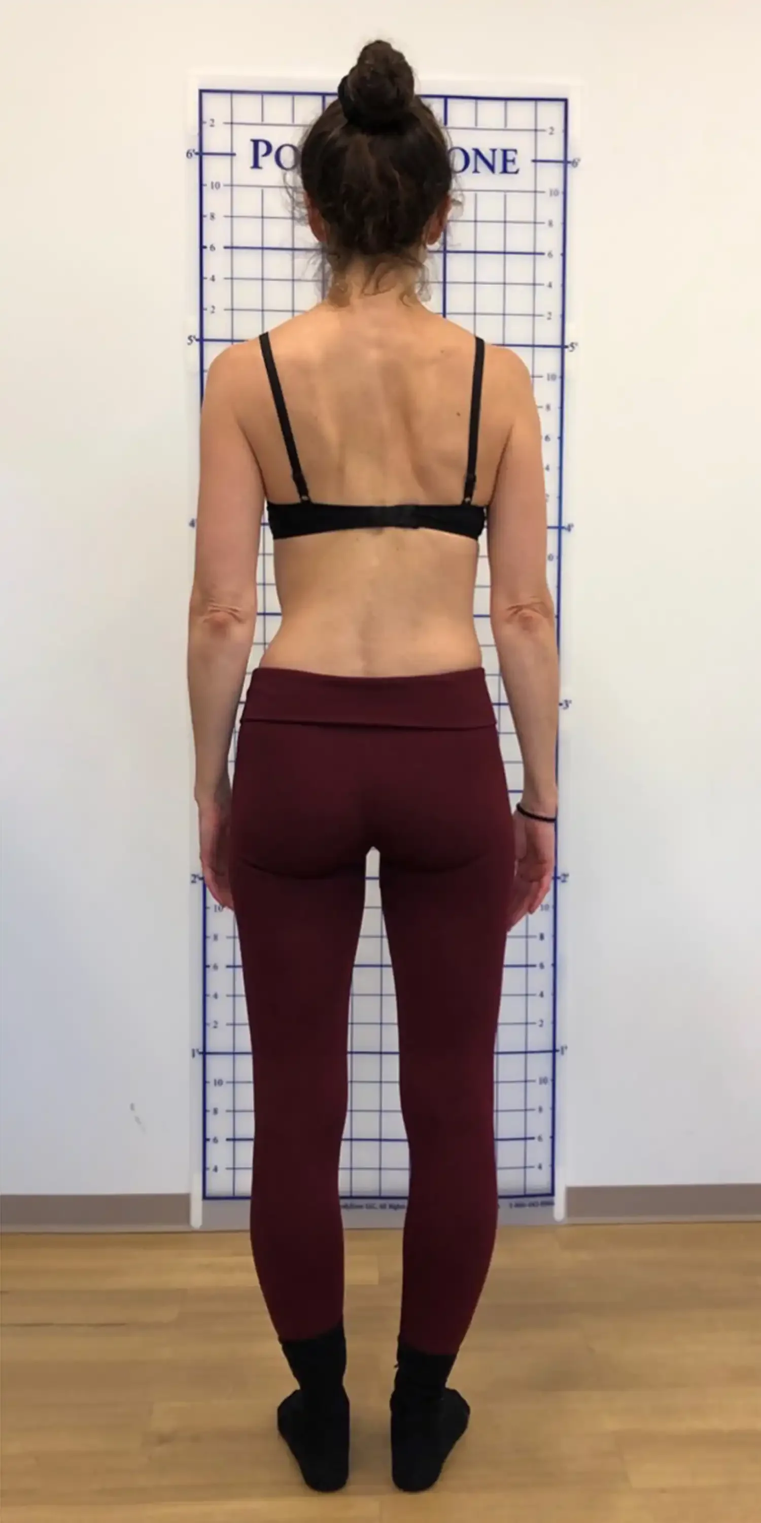 after scoliosis transformation