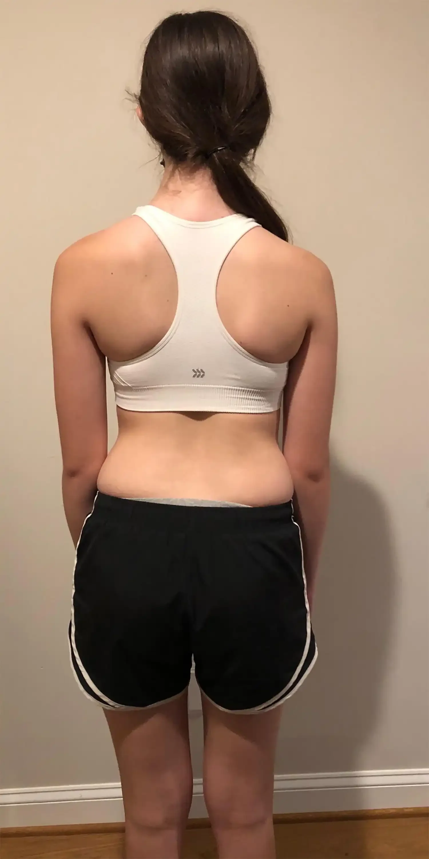 after scoliosis transformation